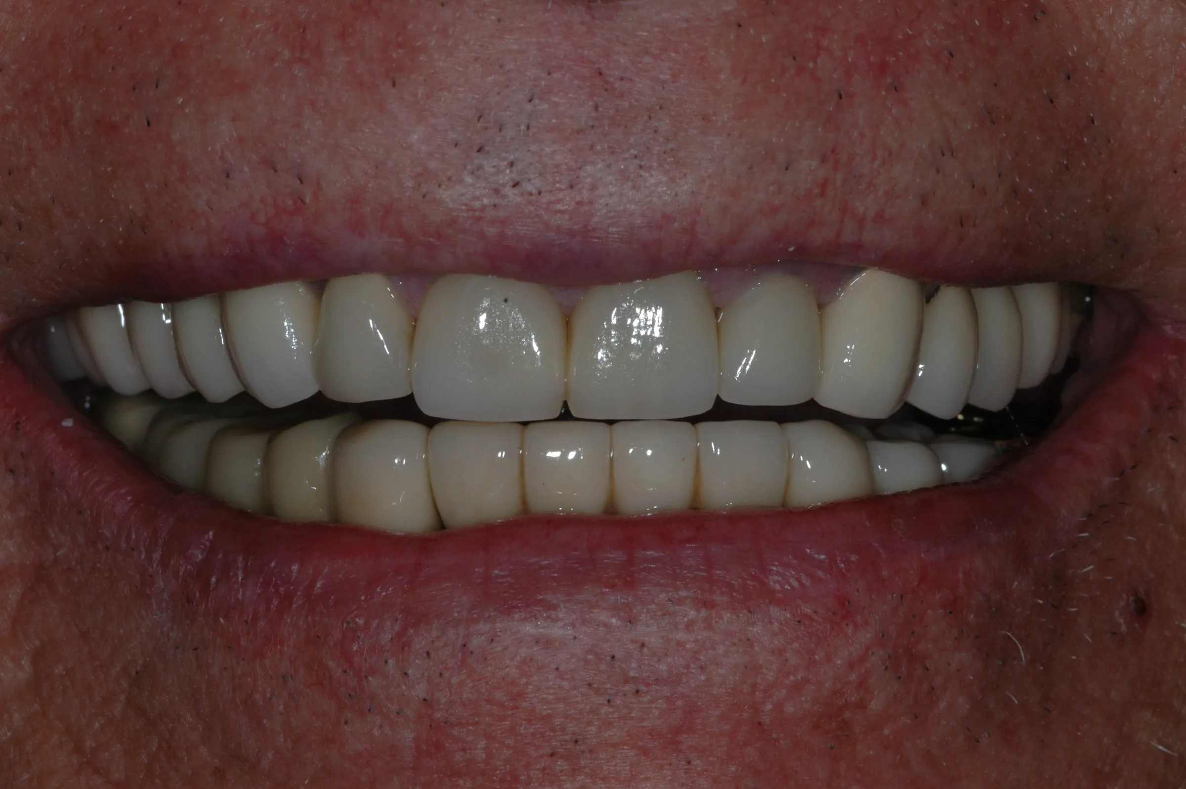 After — Full-Mouth Makeover