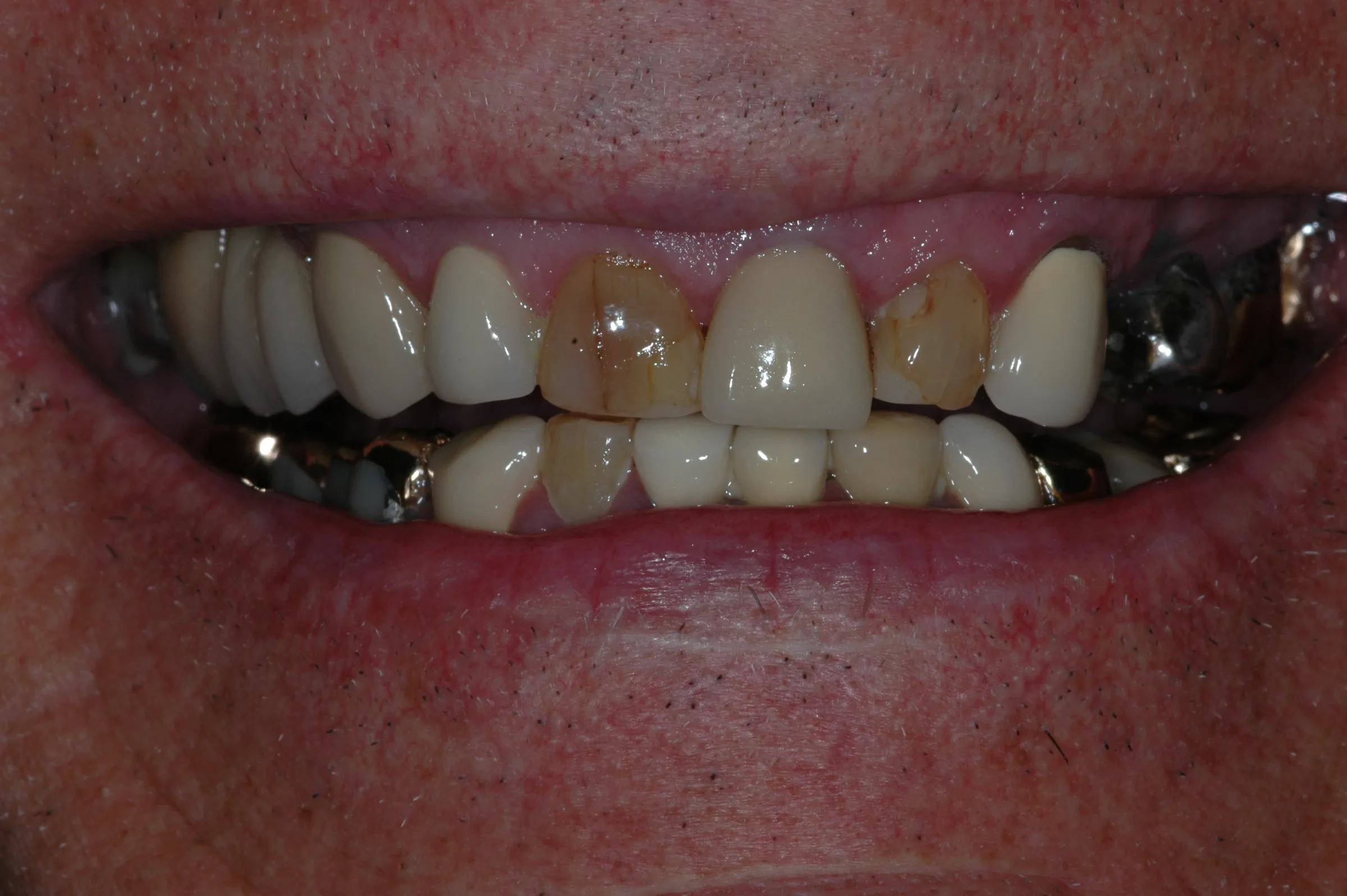 Before — Full-Mouth Makeover