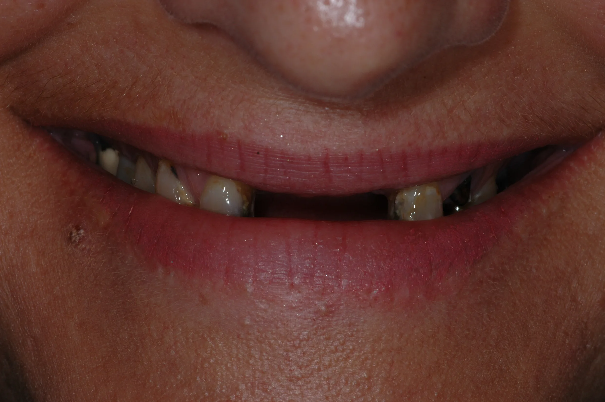 Before — Dentures