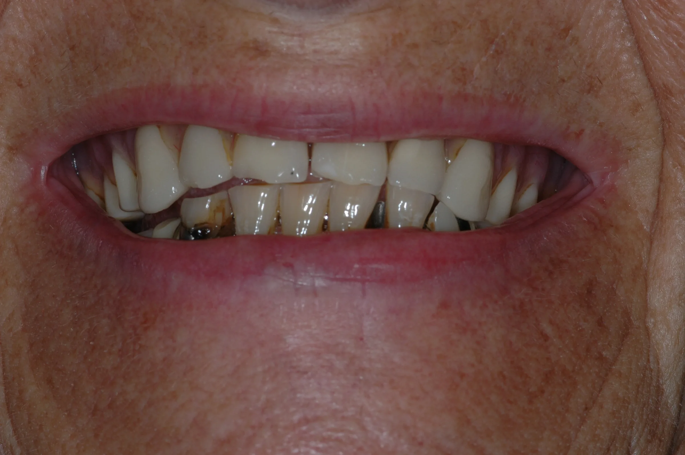 Before — Replacement Dentures