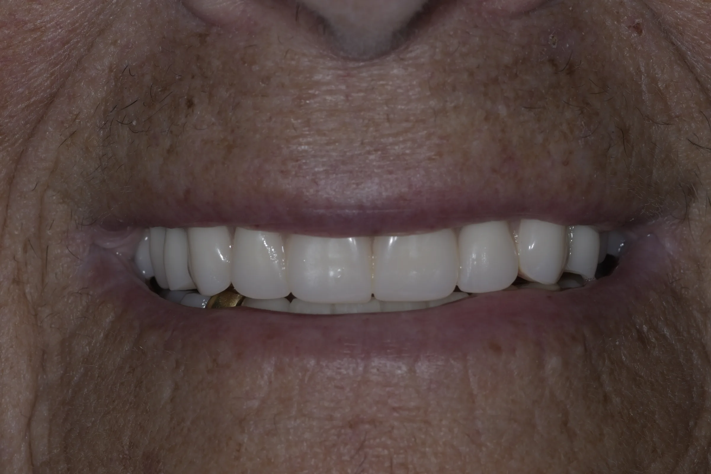 After — Full Mouth Reconstruction