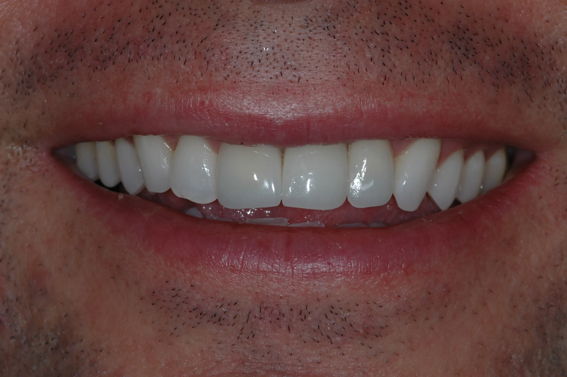After — Dental Implants