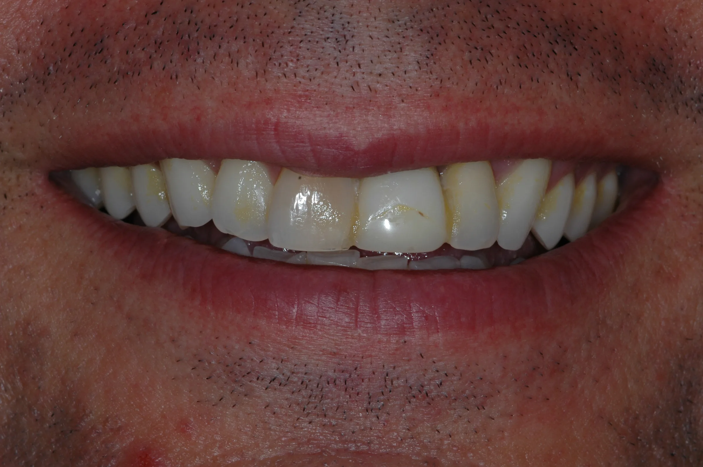 Before — Dental Implants