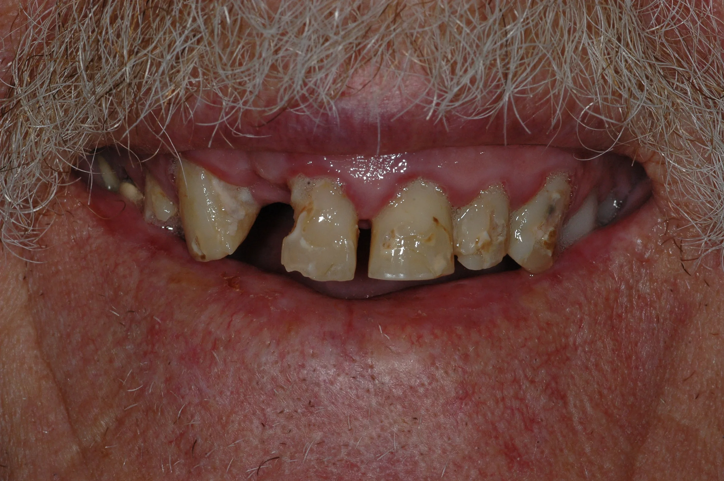 Before — Dentures
