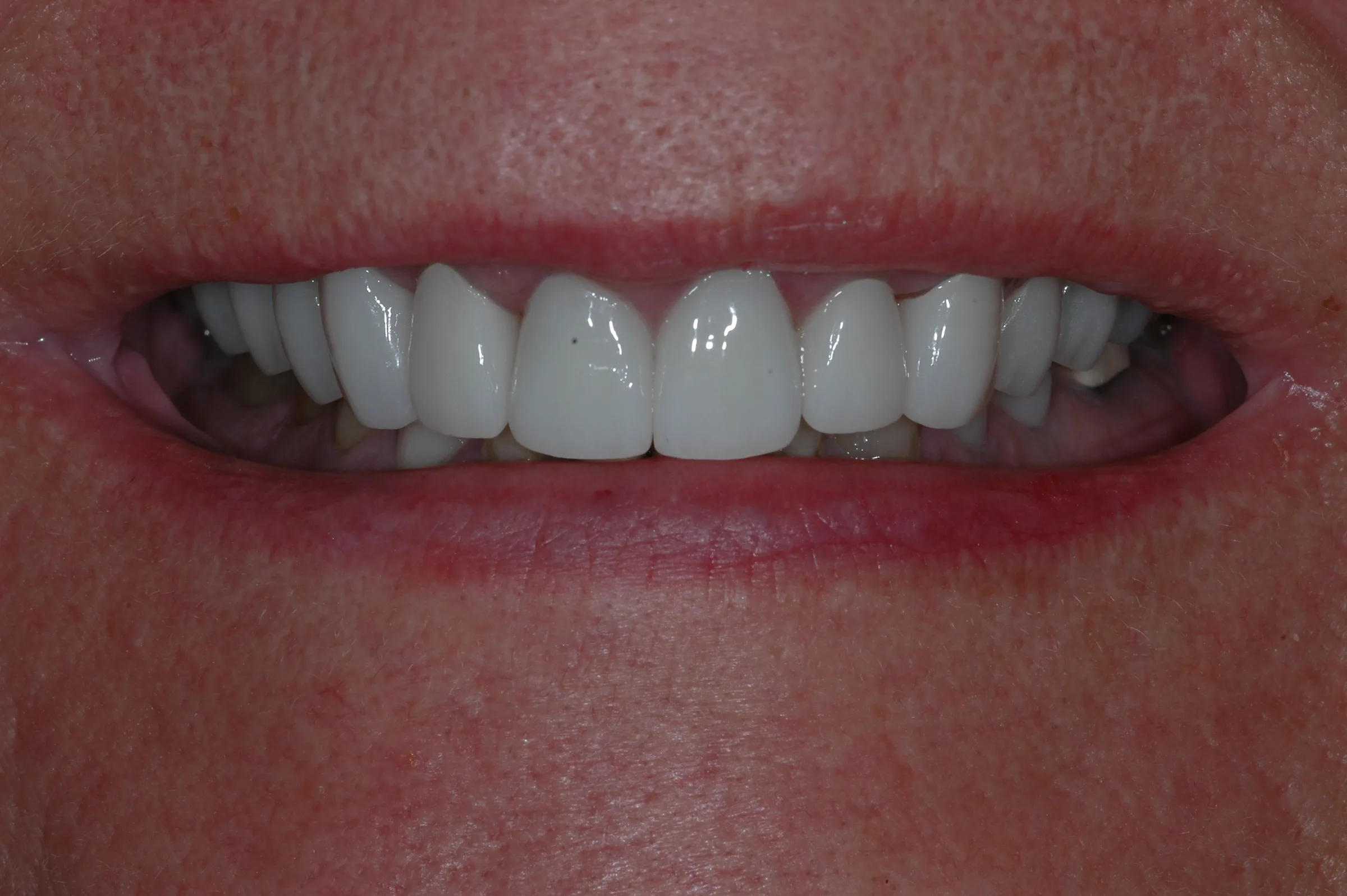 After — Full Mouth Reconstruction