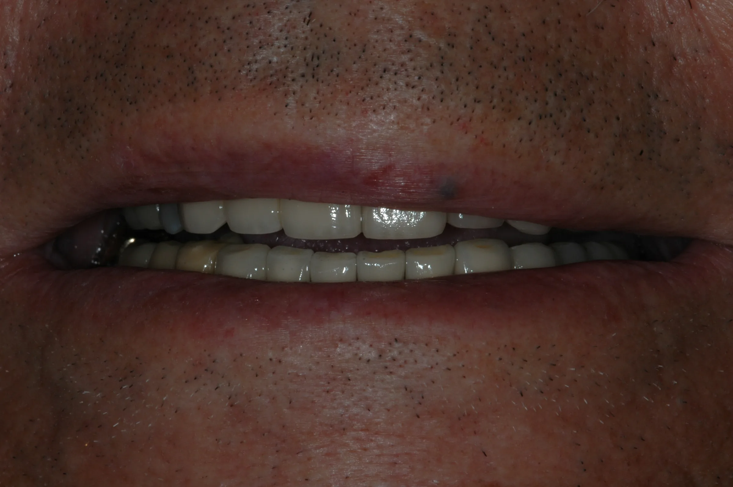 After — Full Mouth Reconstruction