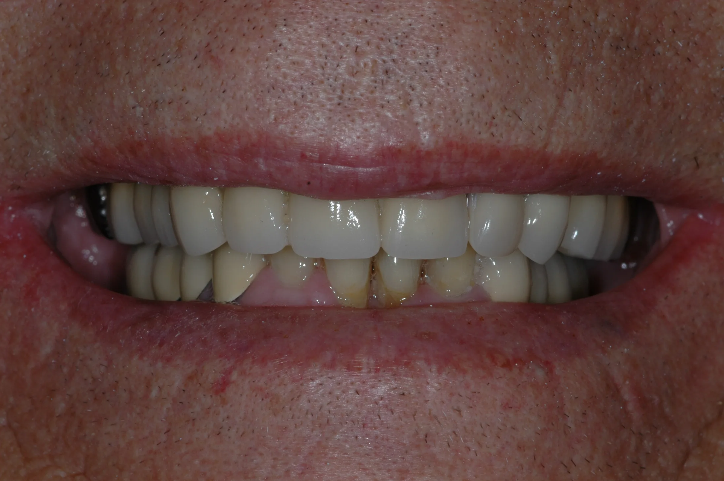After — Full Mouth Reconstruction