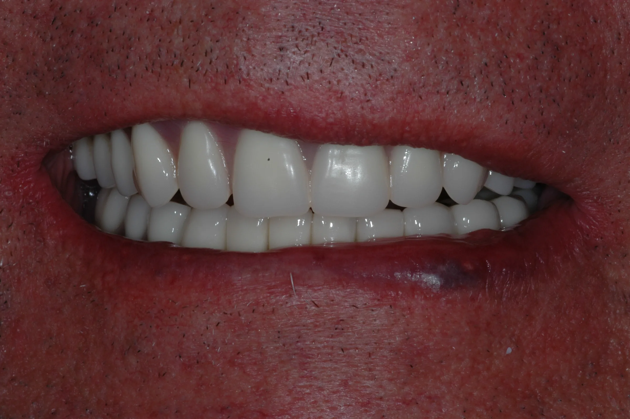 After — Full Mouth Reconstruction