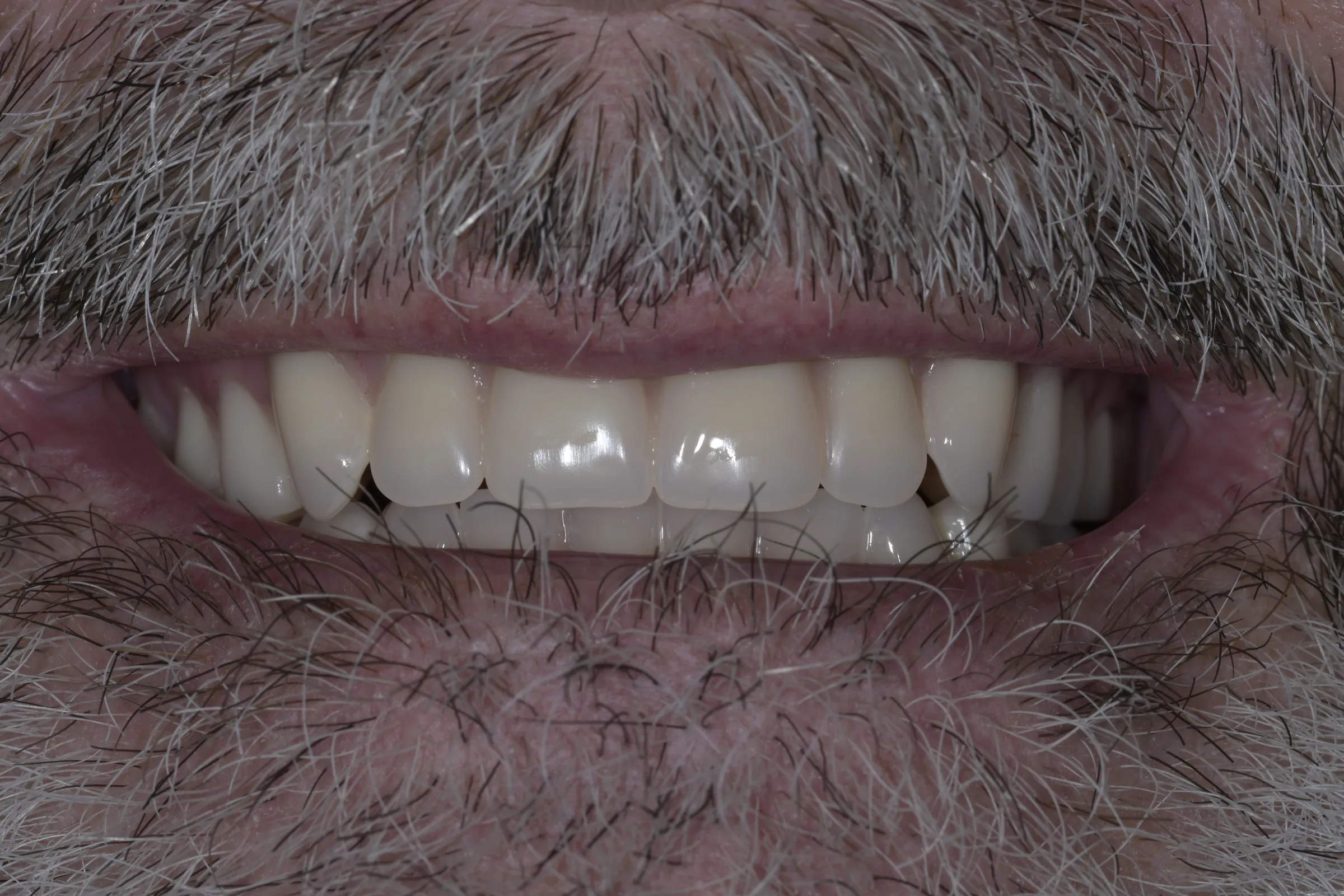 After — Implant-Retained Dentures
