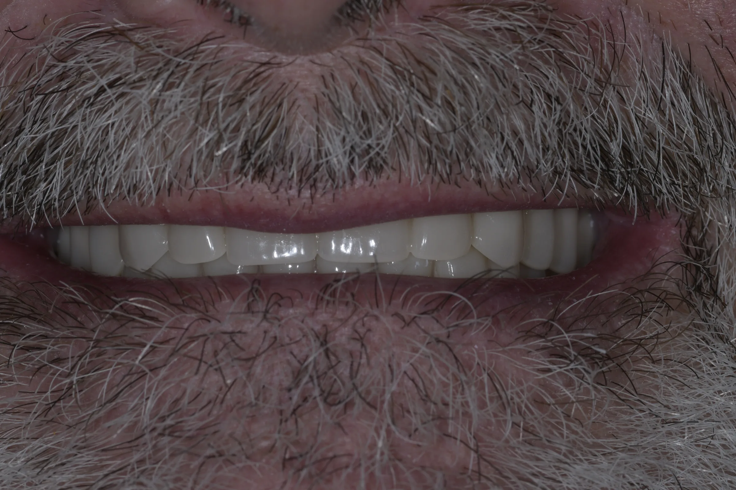 Before — Implant-Retained Dentures