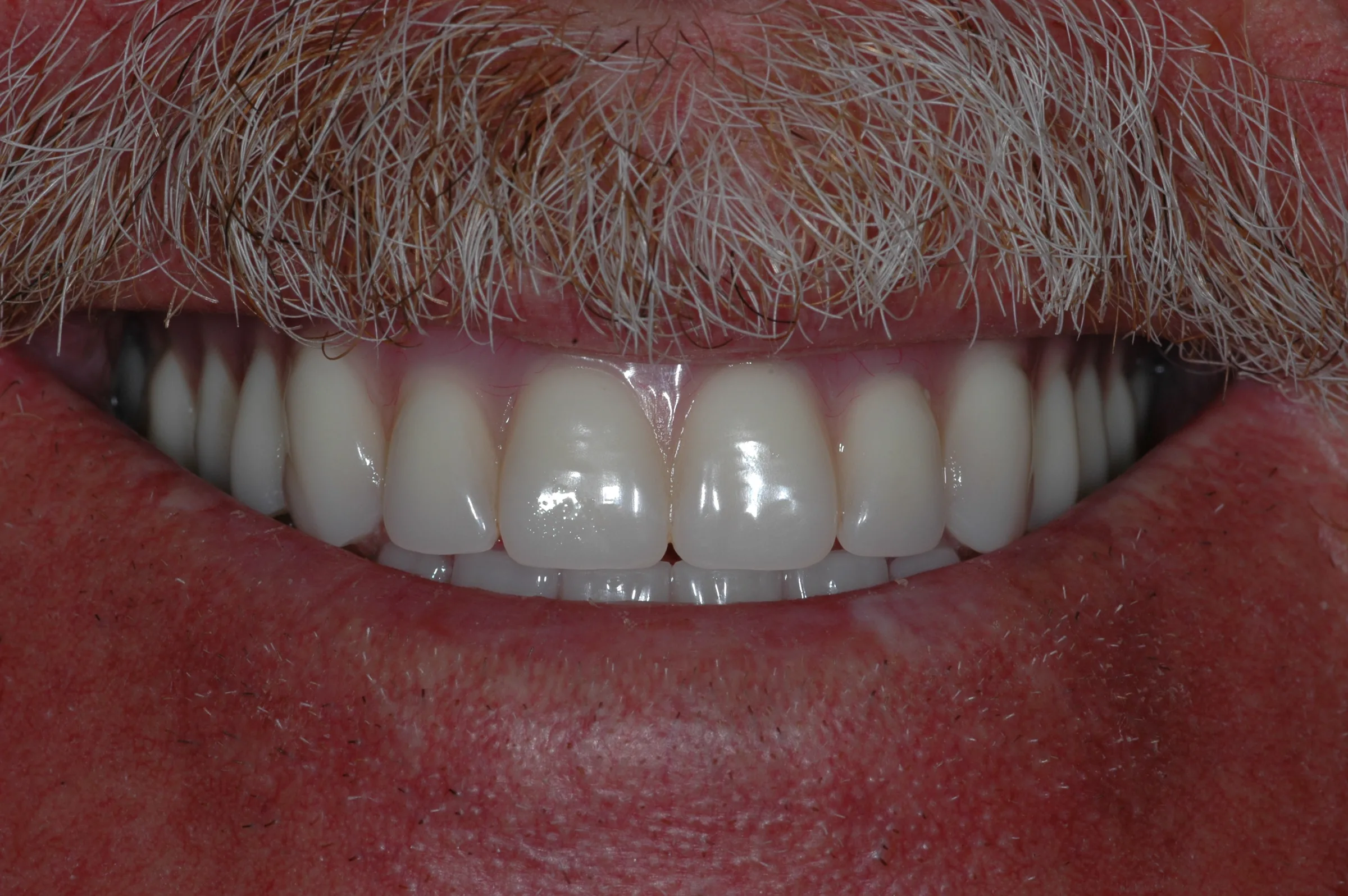 After — Snap-On Denture