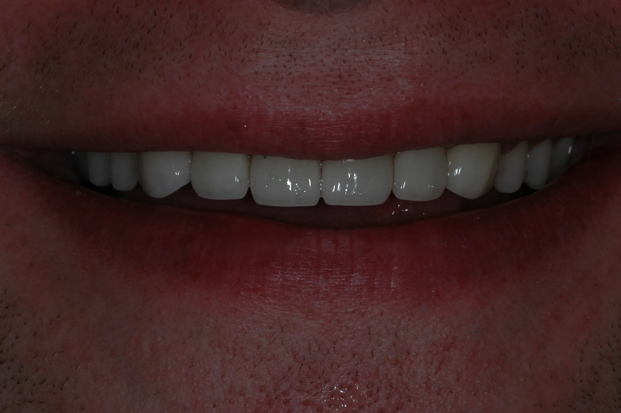 After — Cosmetic Zirconia Crowns