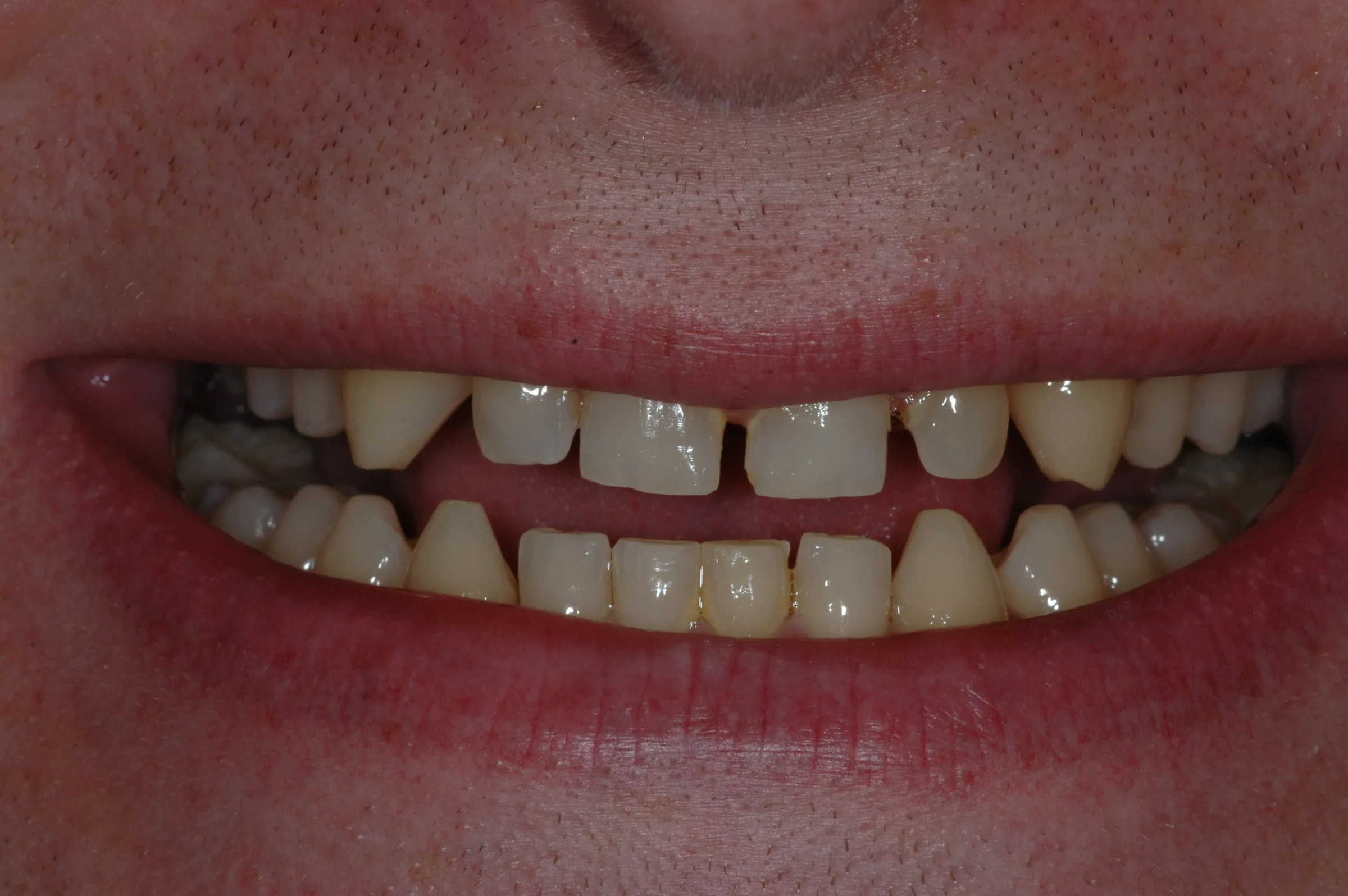 Before — Cosmetic Zirconia Crowns