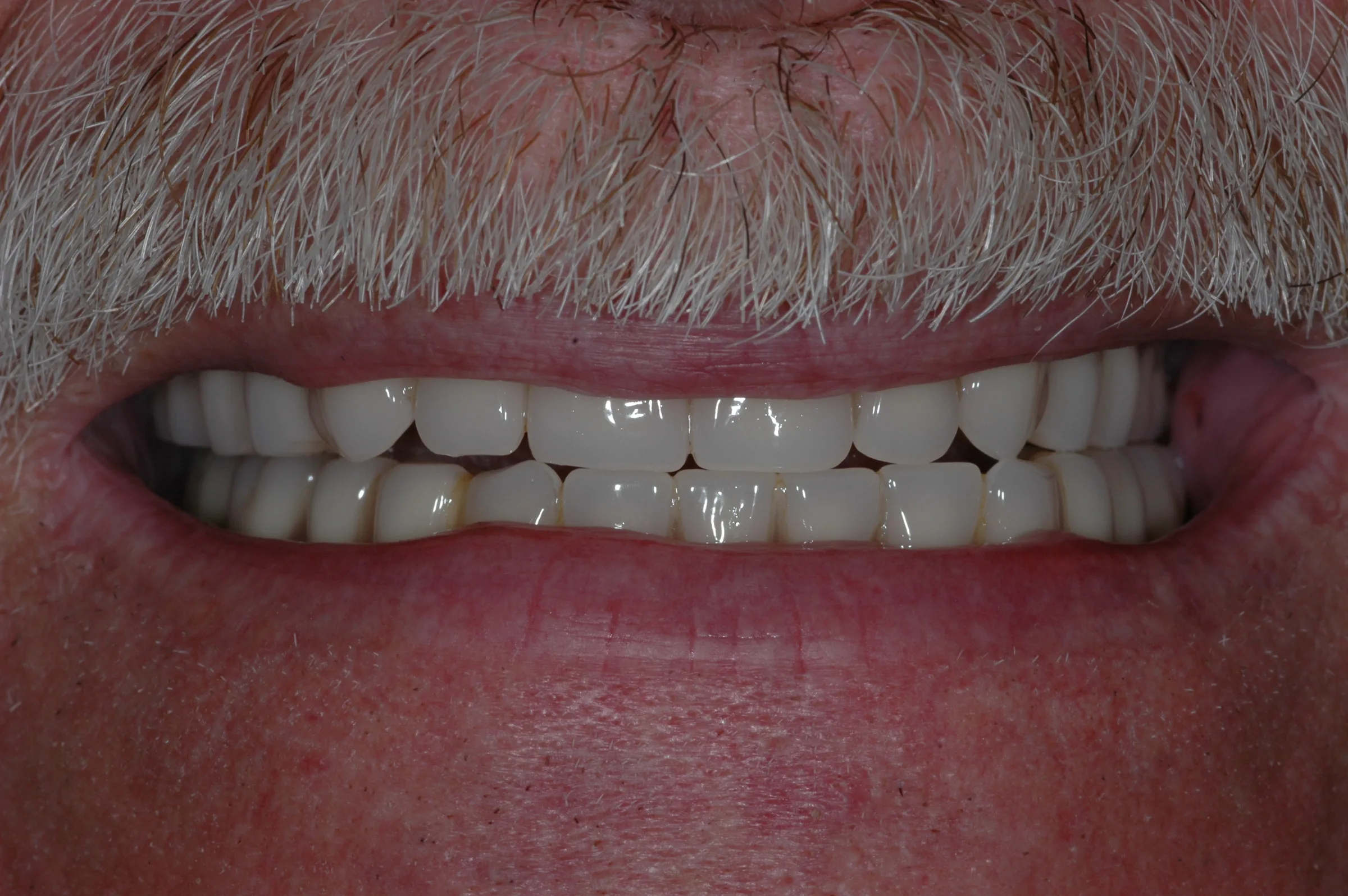 After — Dentures