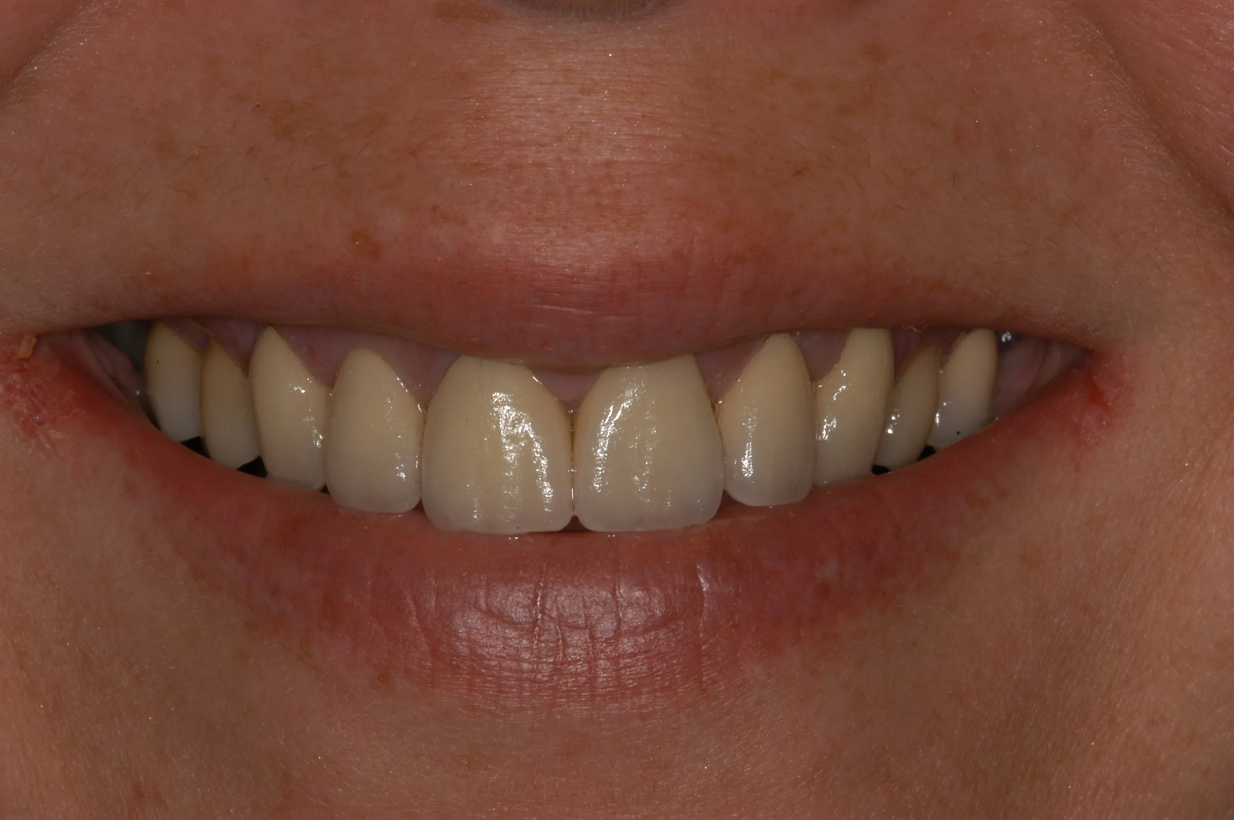 After — e.max Crowns & Veneers