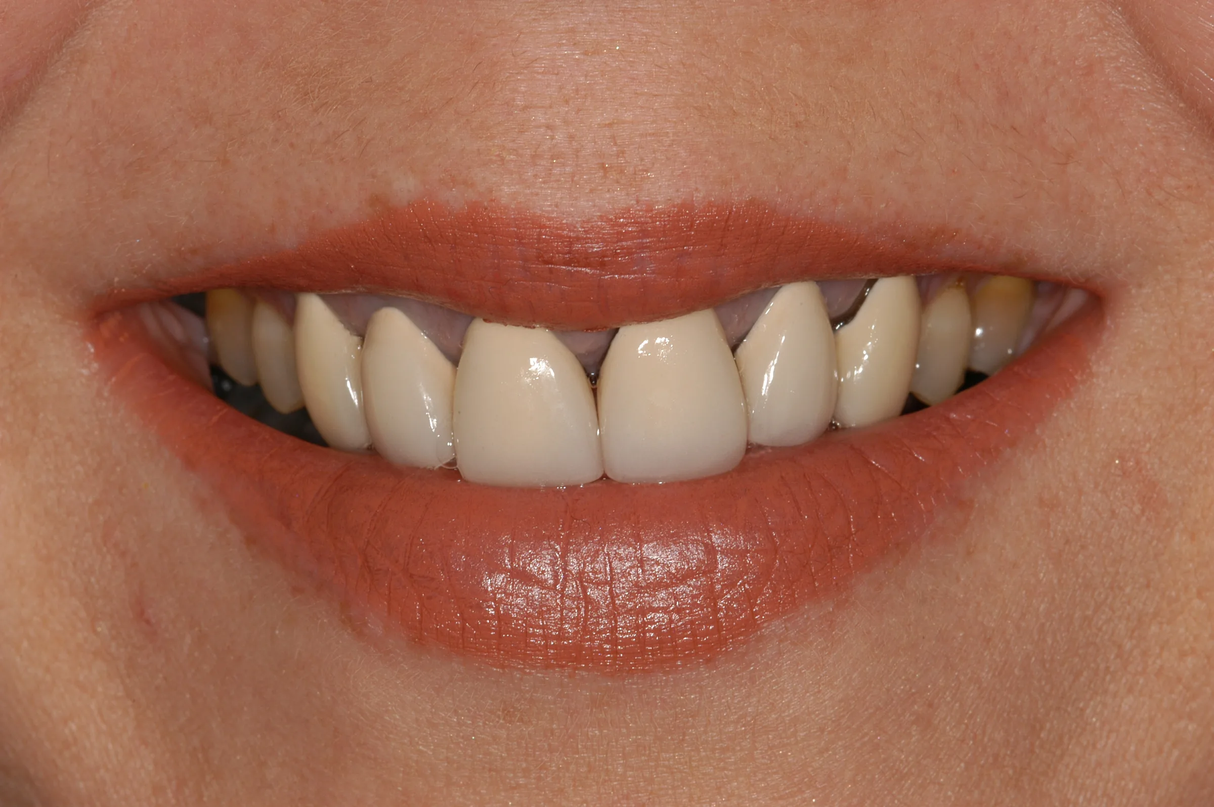 Before — e.max Crowns & Veneers