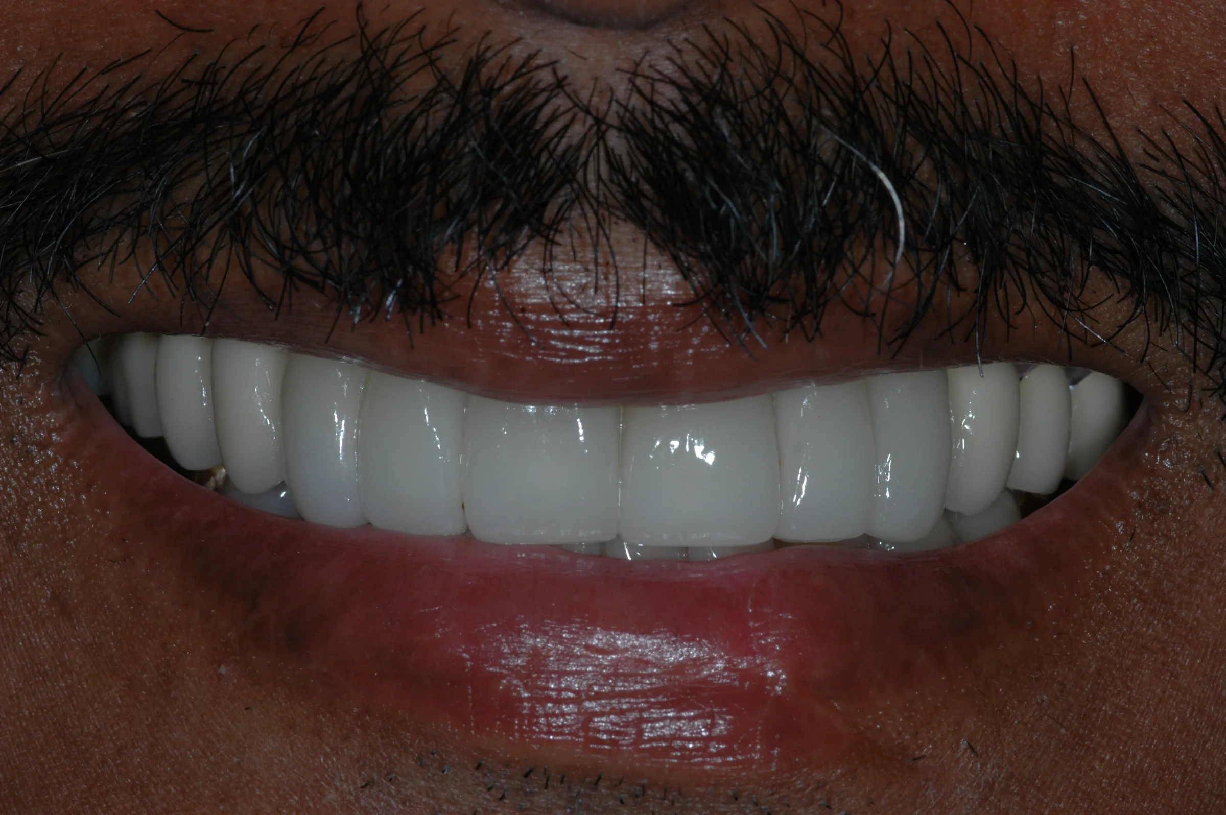 After — Fixed Implant Prosthesis