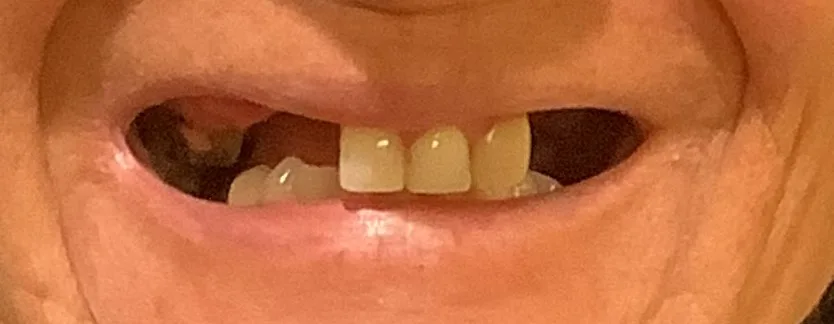 Before — Dentures