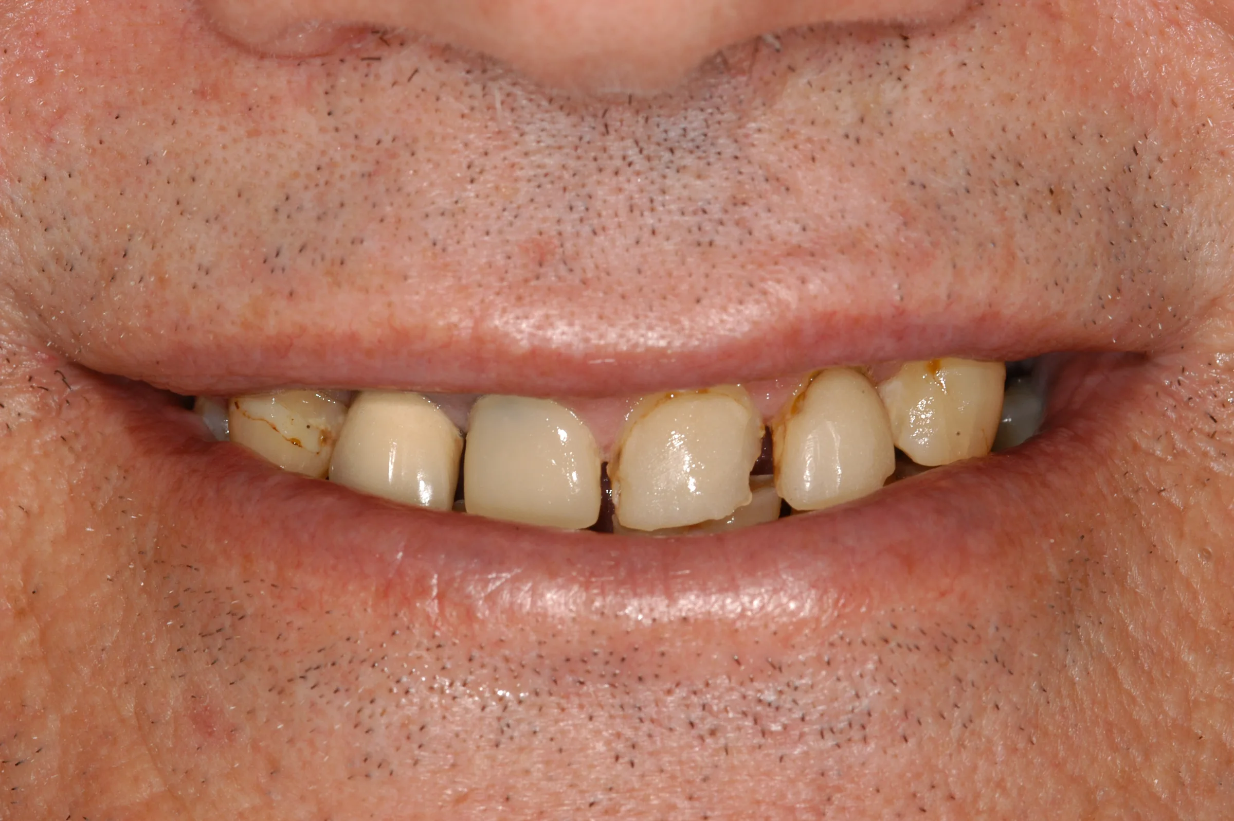 Before — Full Mouth Reconstruction