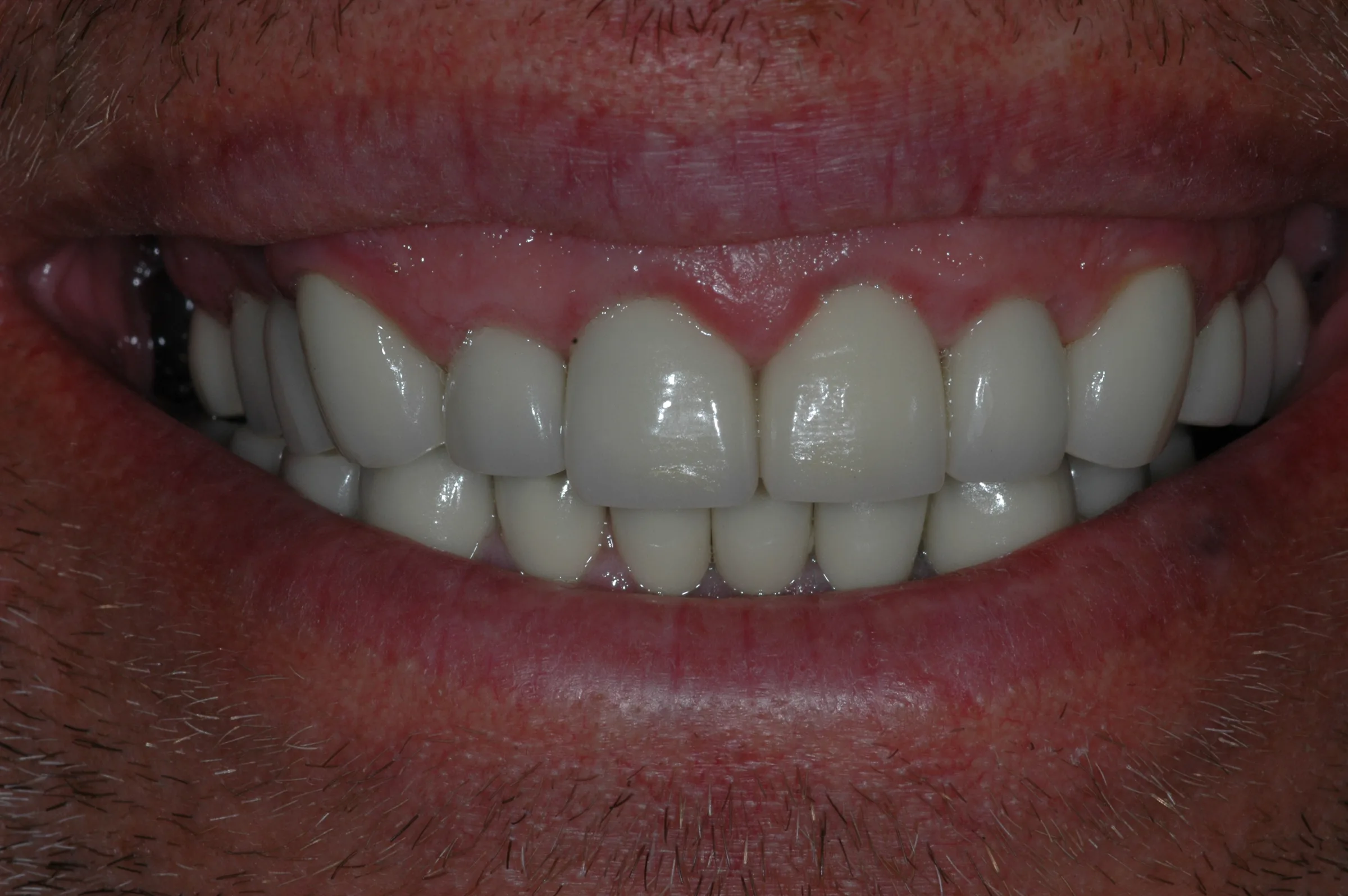 After — Full Mouth Reconstruction