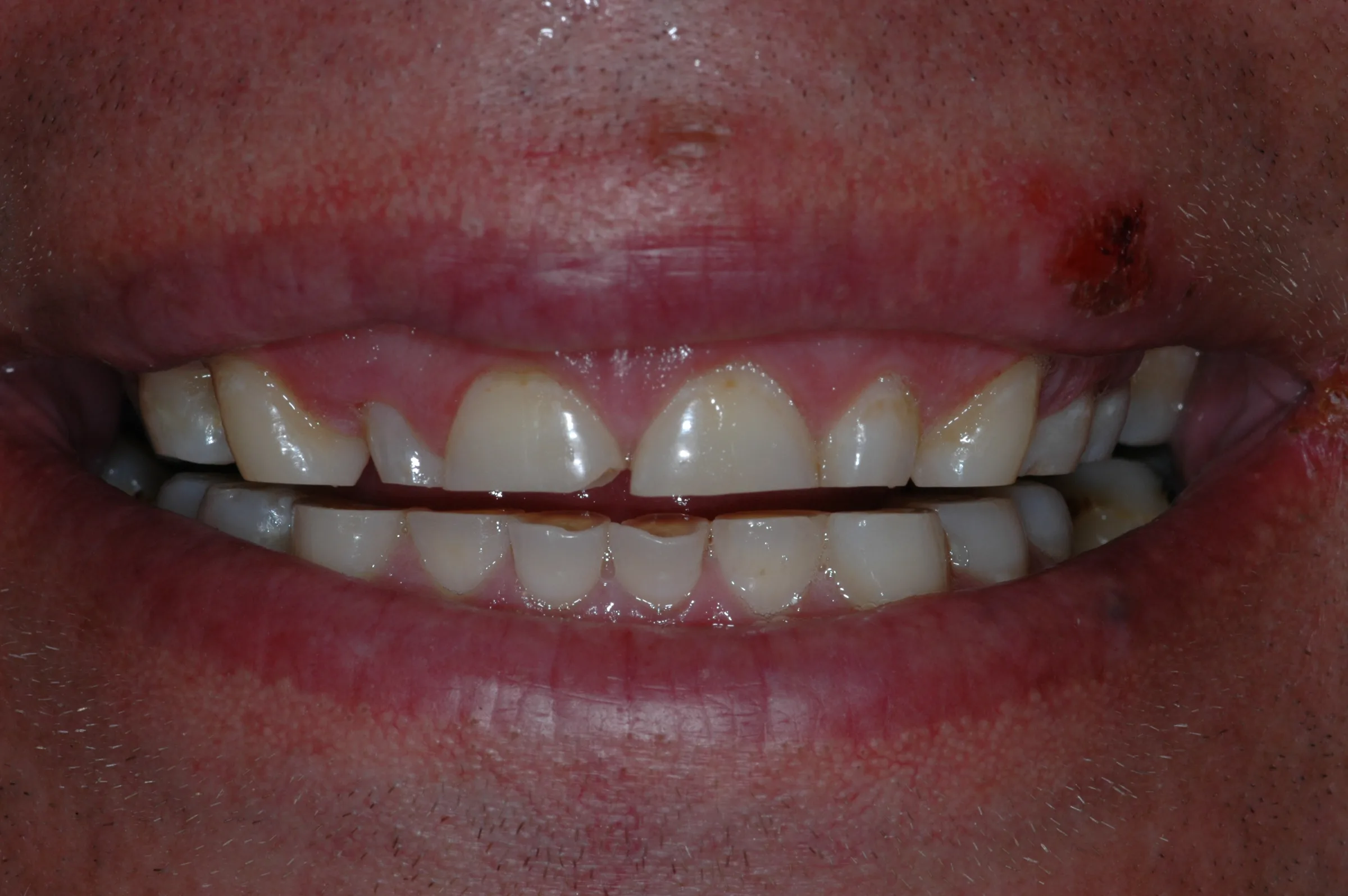 Before — Full Mouth Reconstruction