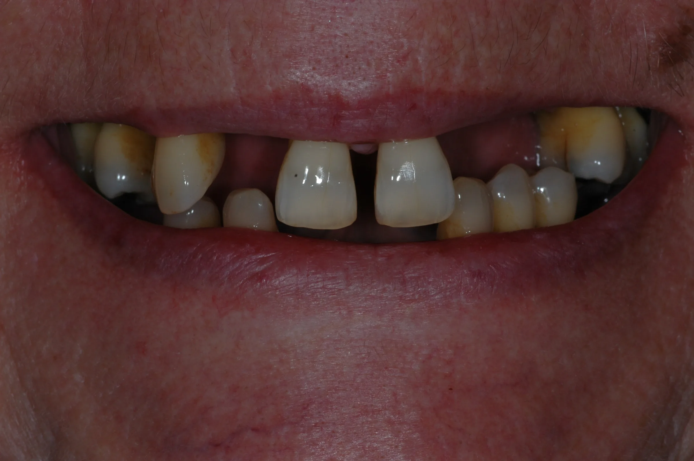 Before — Dentures