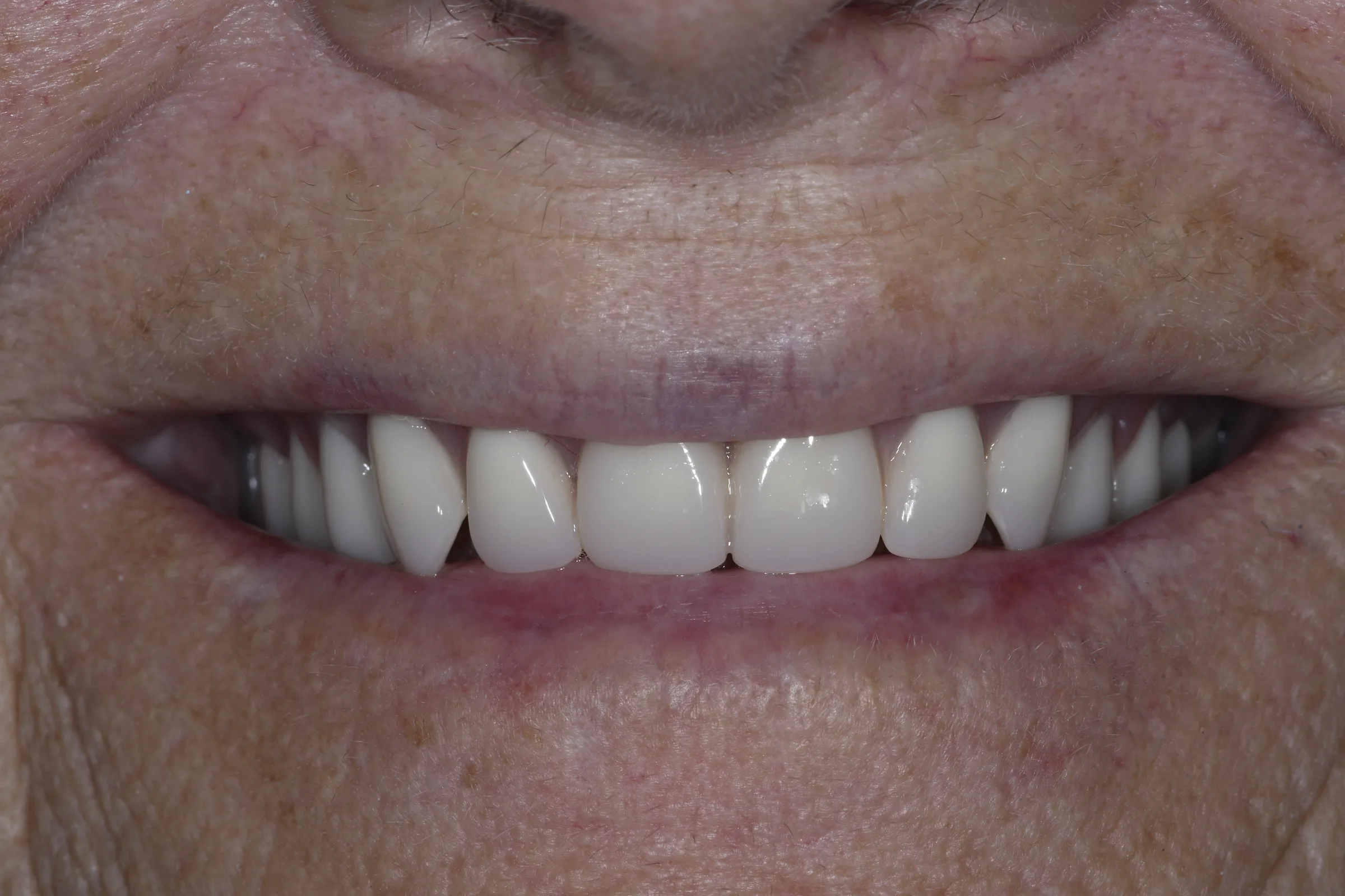 After — Dentures