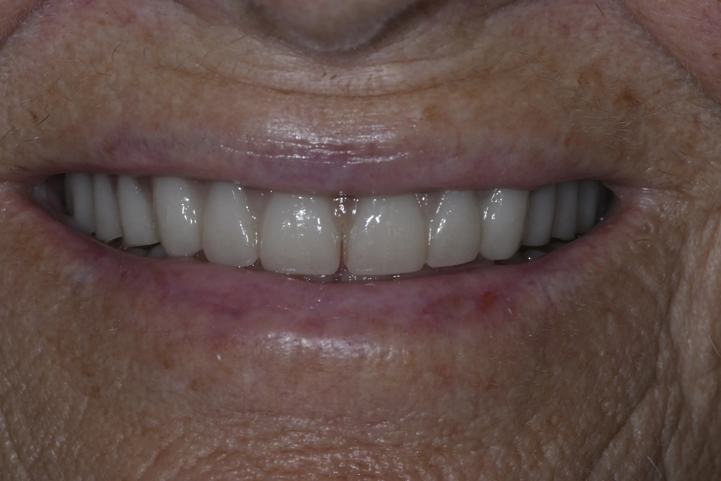 Before — Dentures