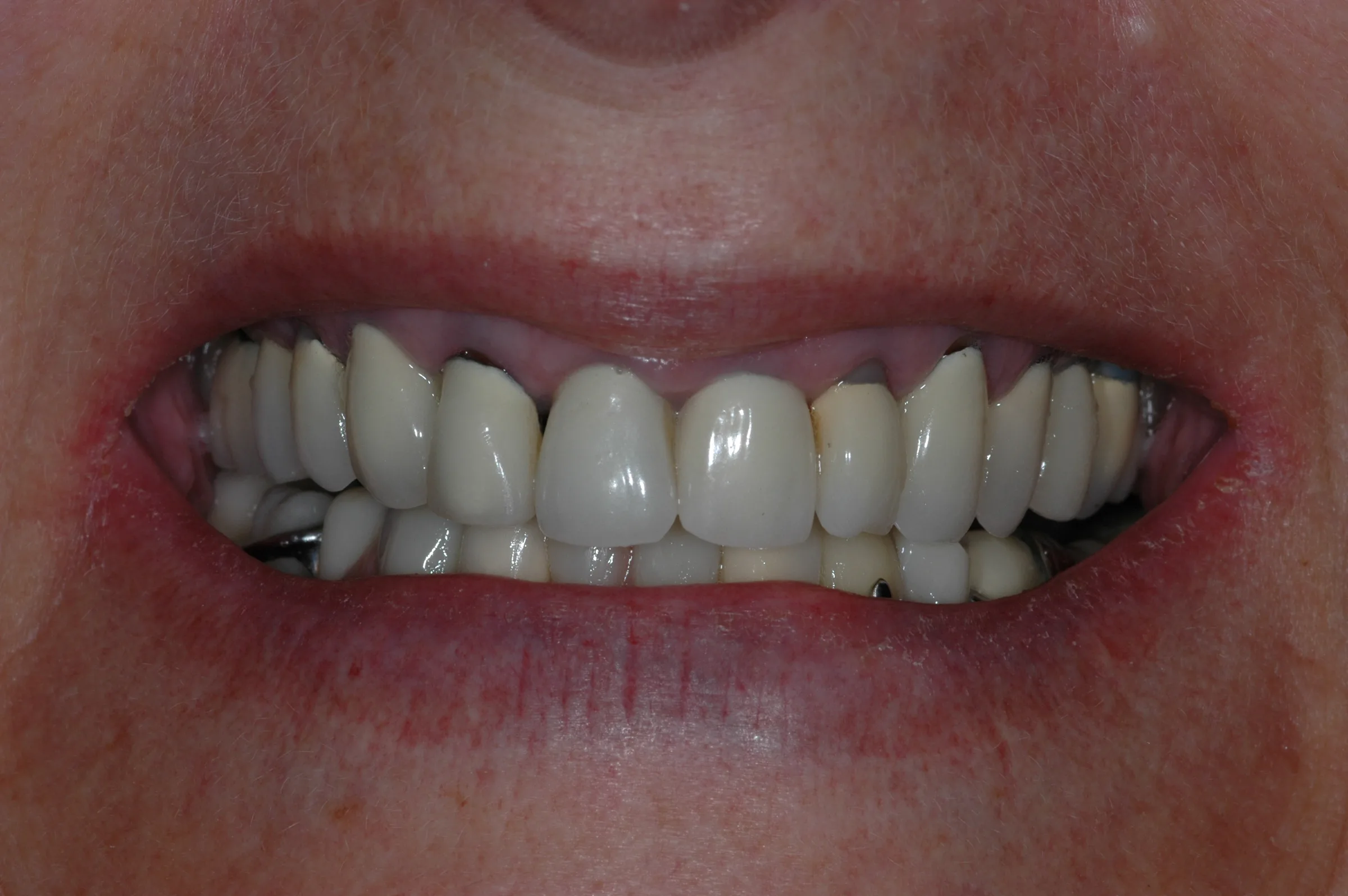 Before — Full Mouth Reconstruction