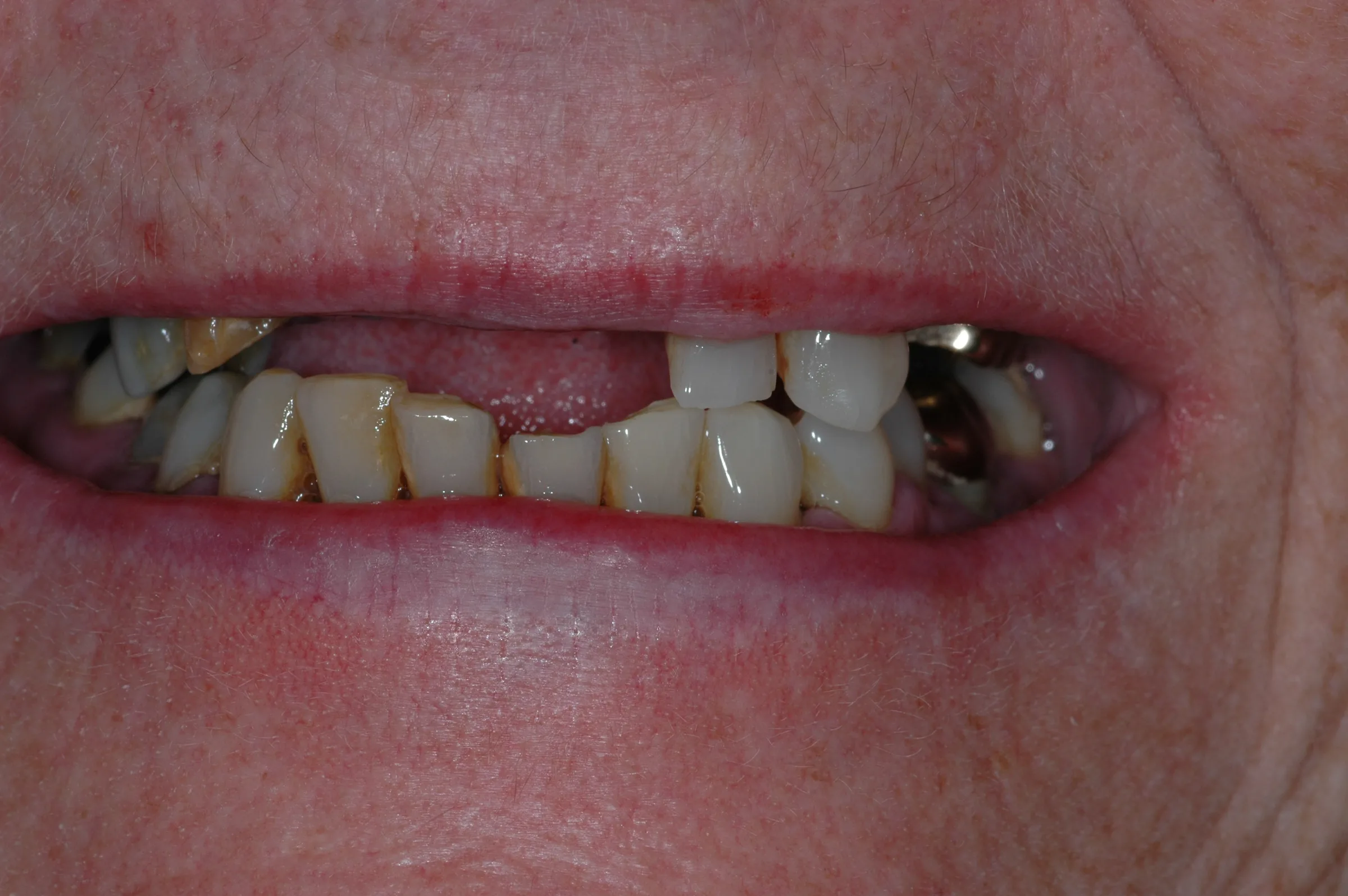 Before — Dentures
