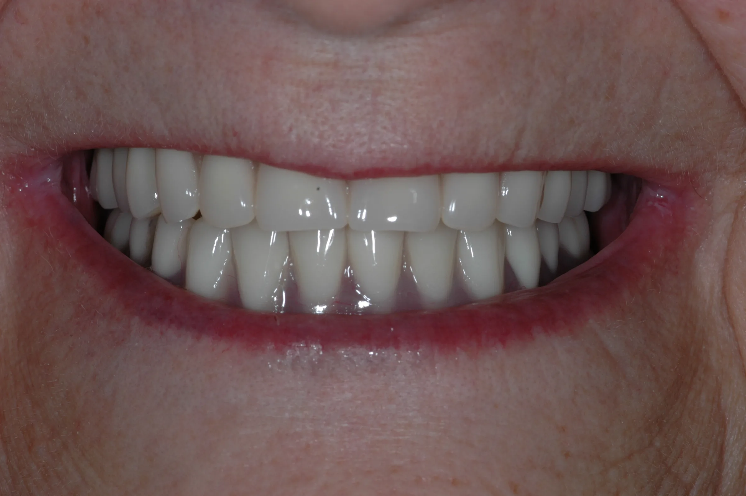 After — All-on-4 / Full Arch