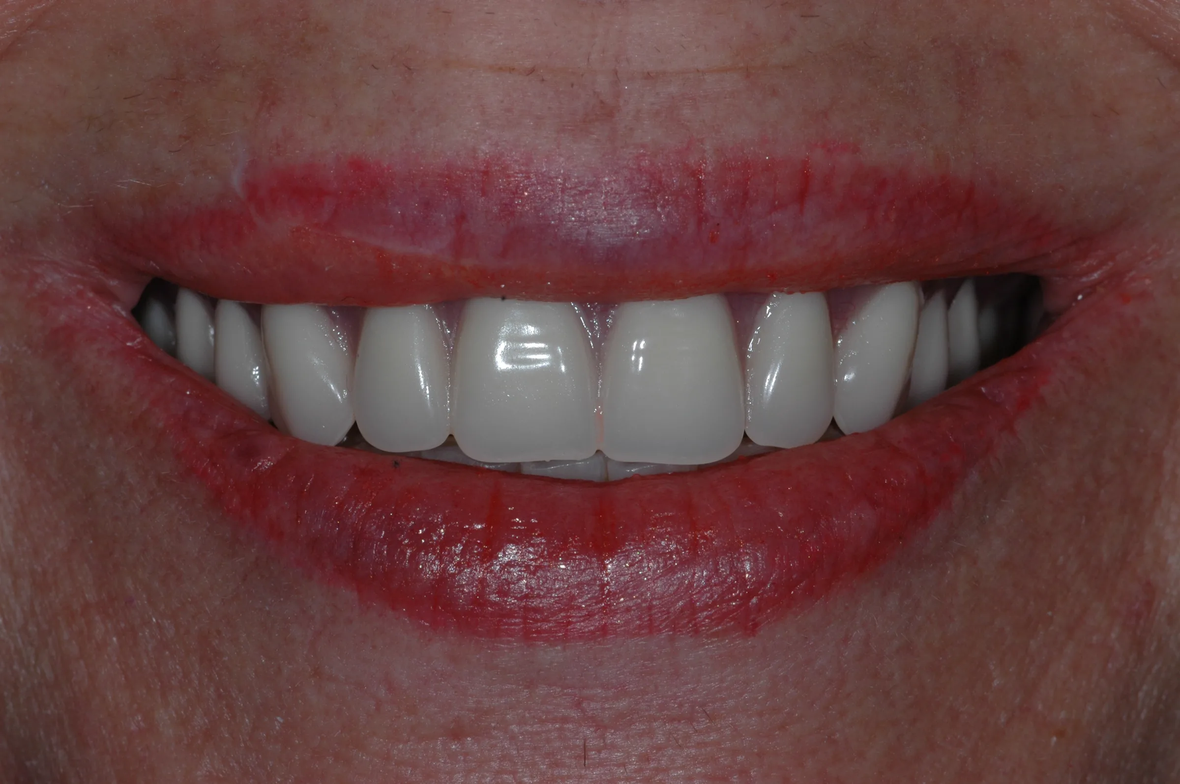 After — Dentures