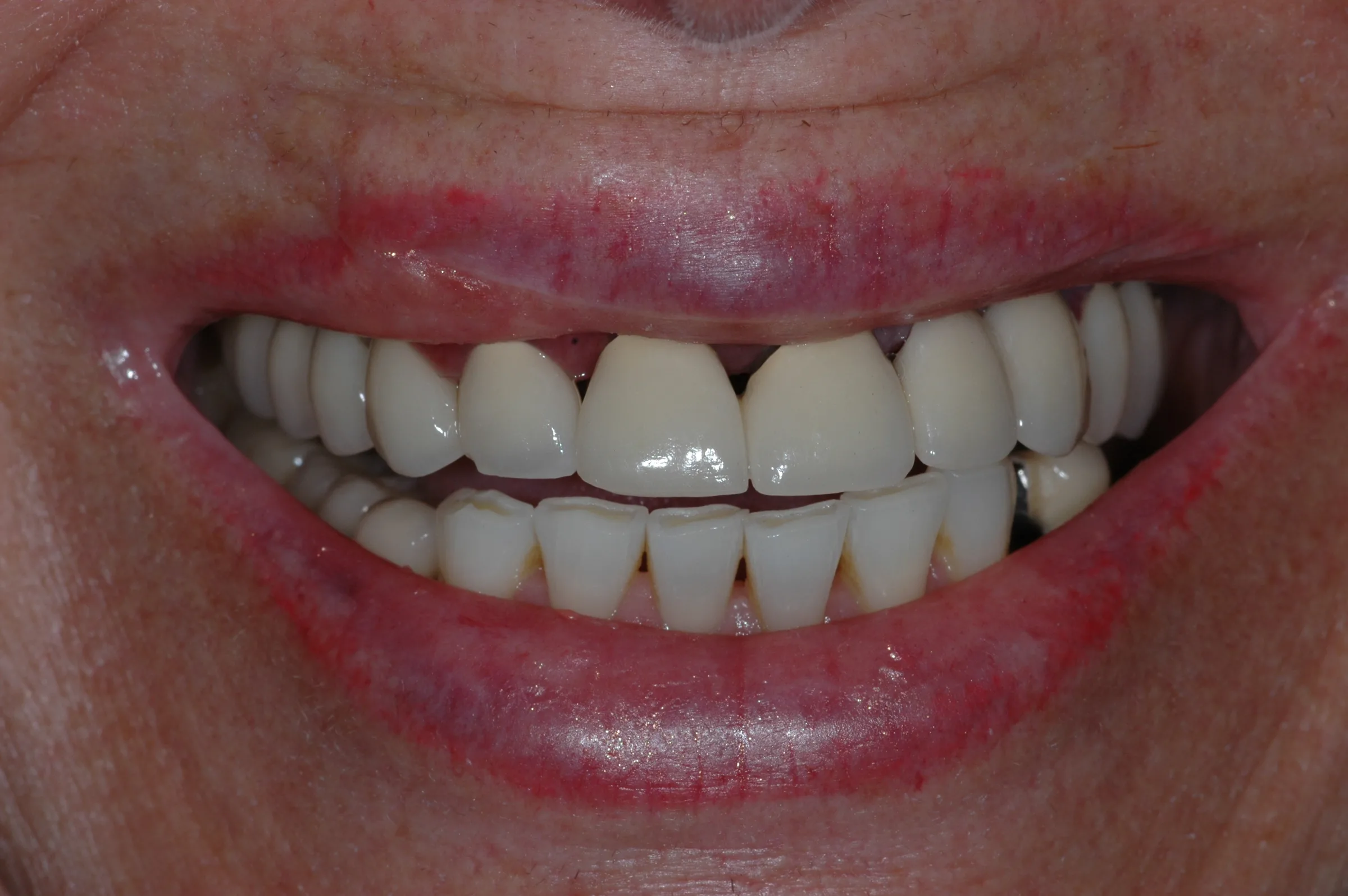 Before — Dentures