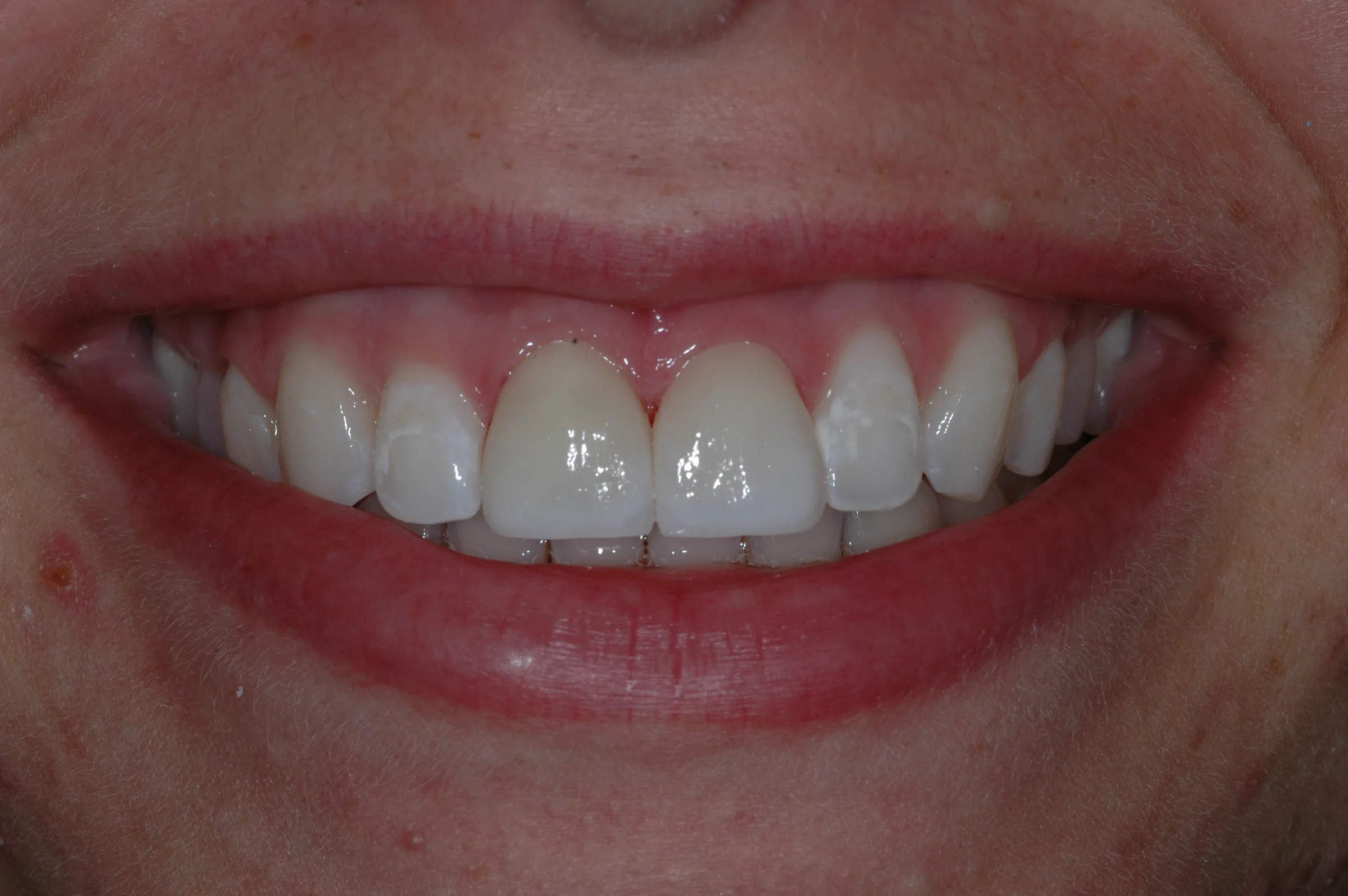 After — Cosmetic Crowns