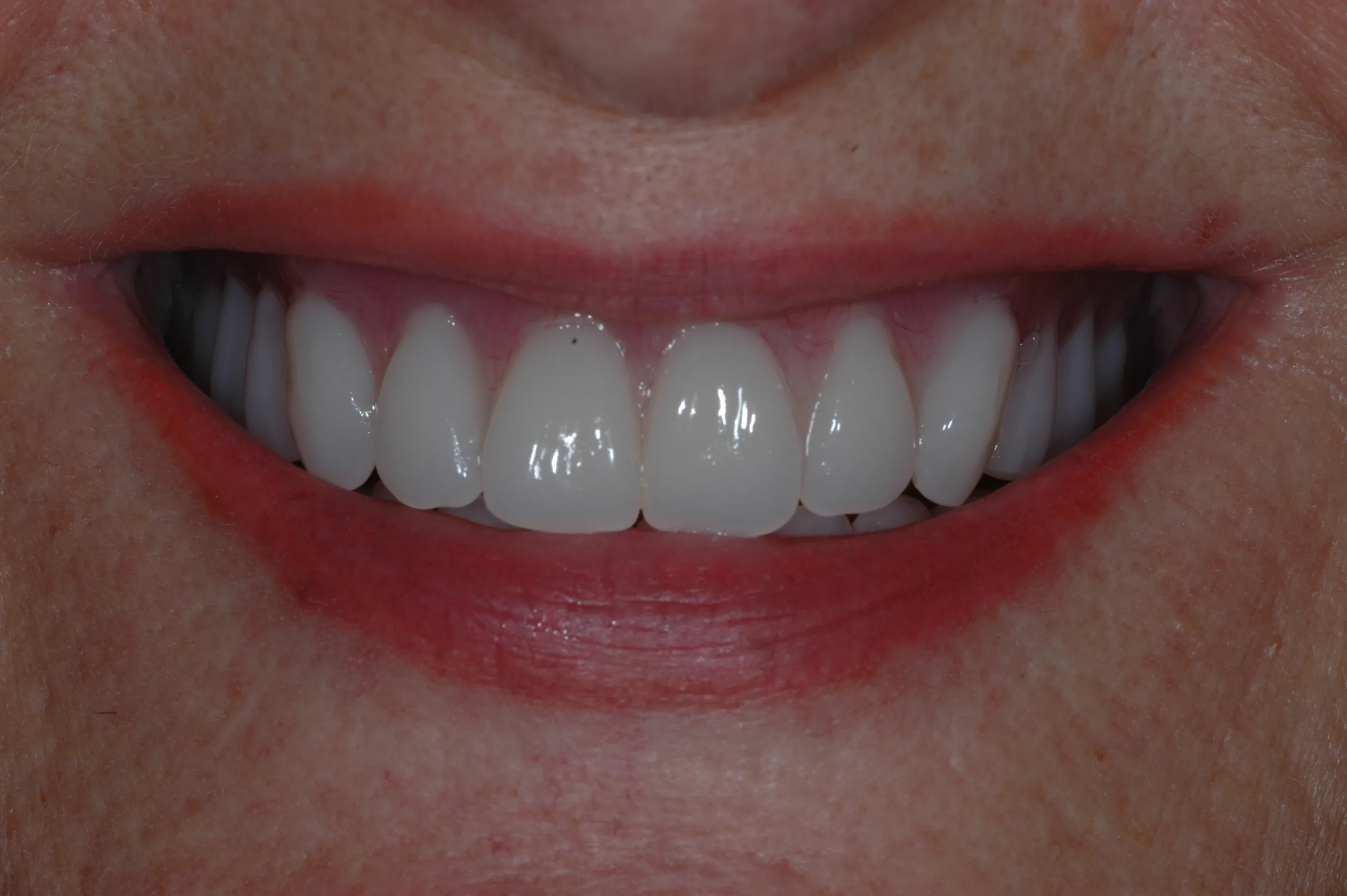 After — Dentures