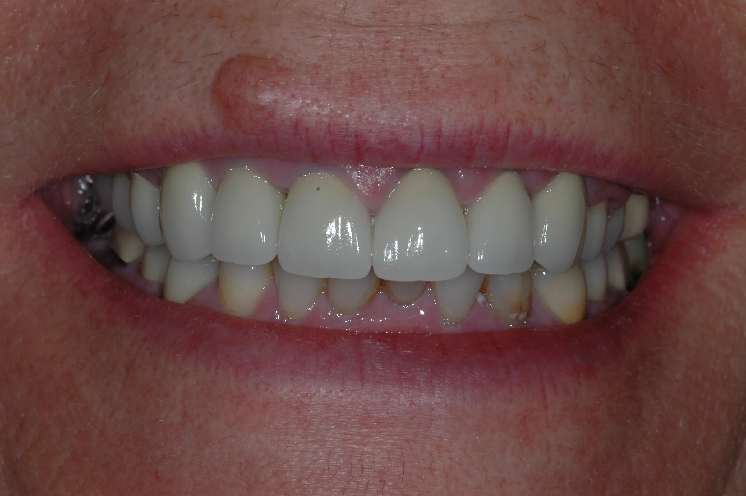 After — Full Mouth Reconstruction