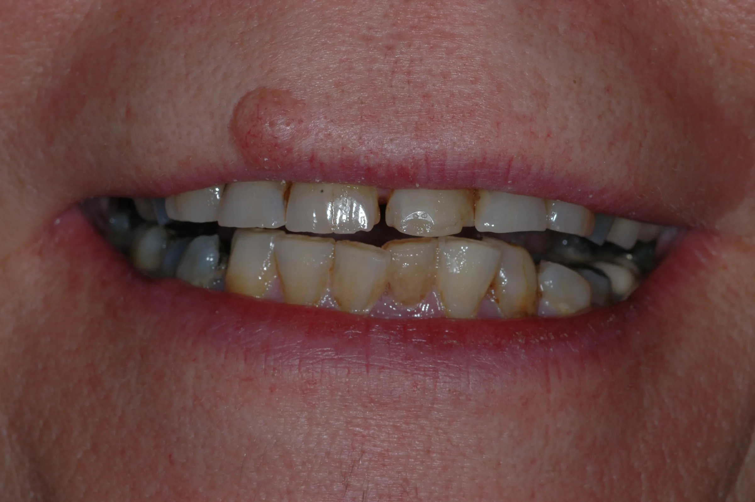 Before — Full Mouth Reconstruction