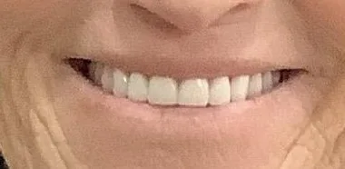 After — Crowns