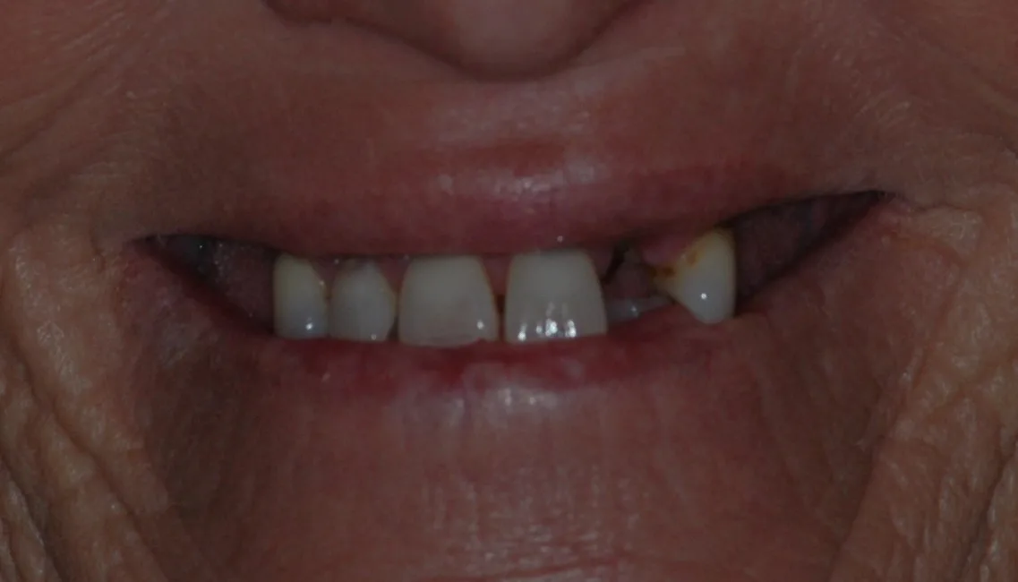Before — Crowns