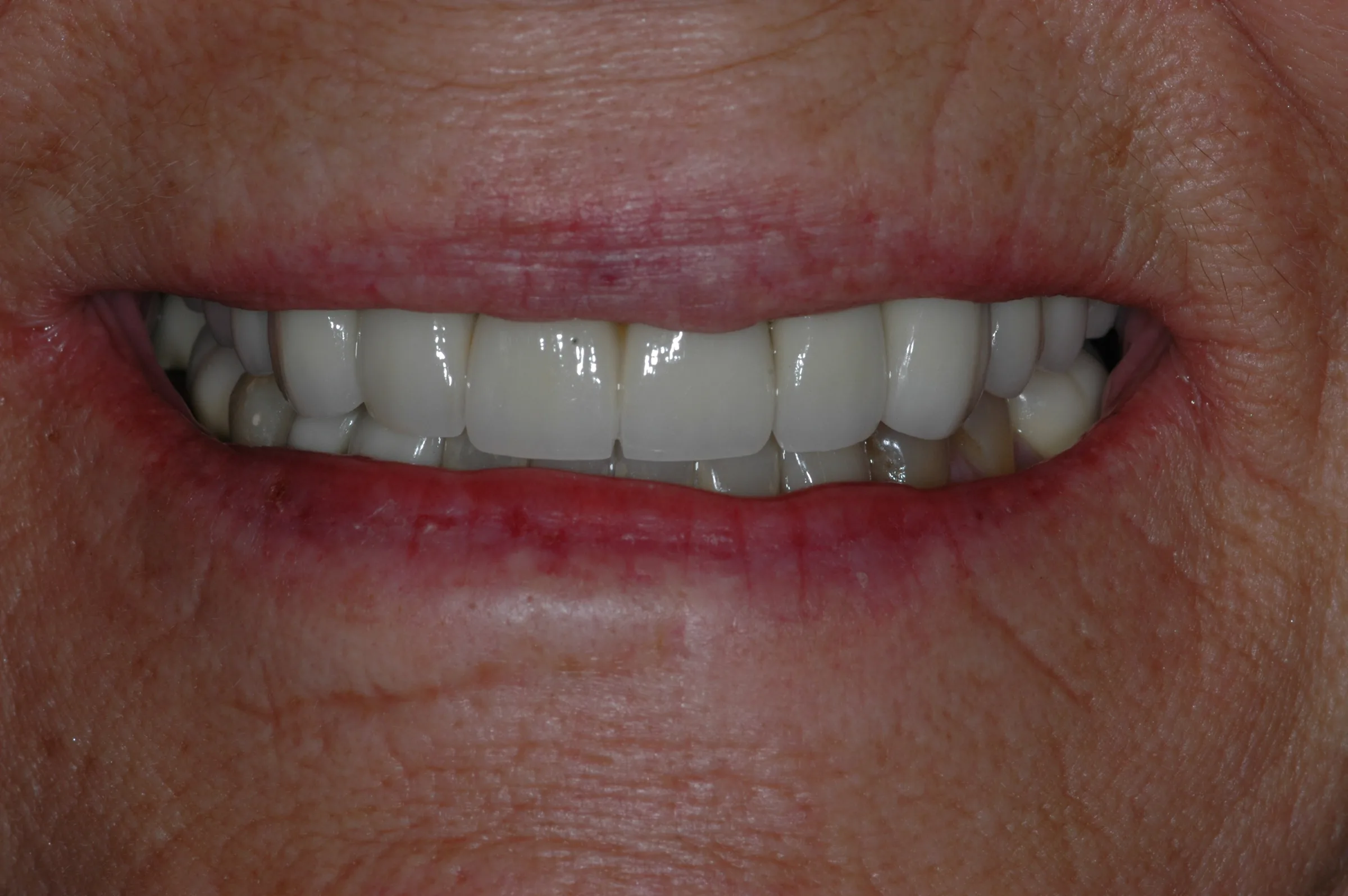 After — Full Mouth Reconstruction