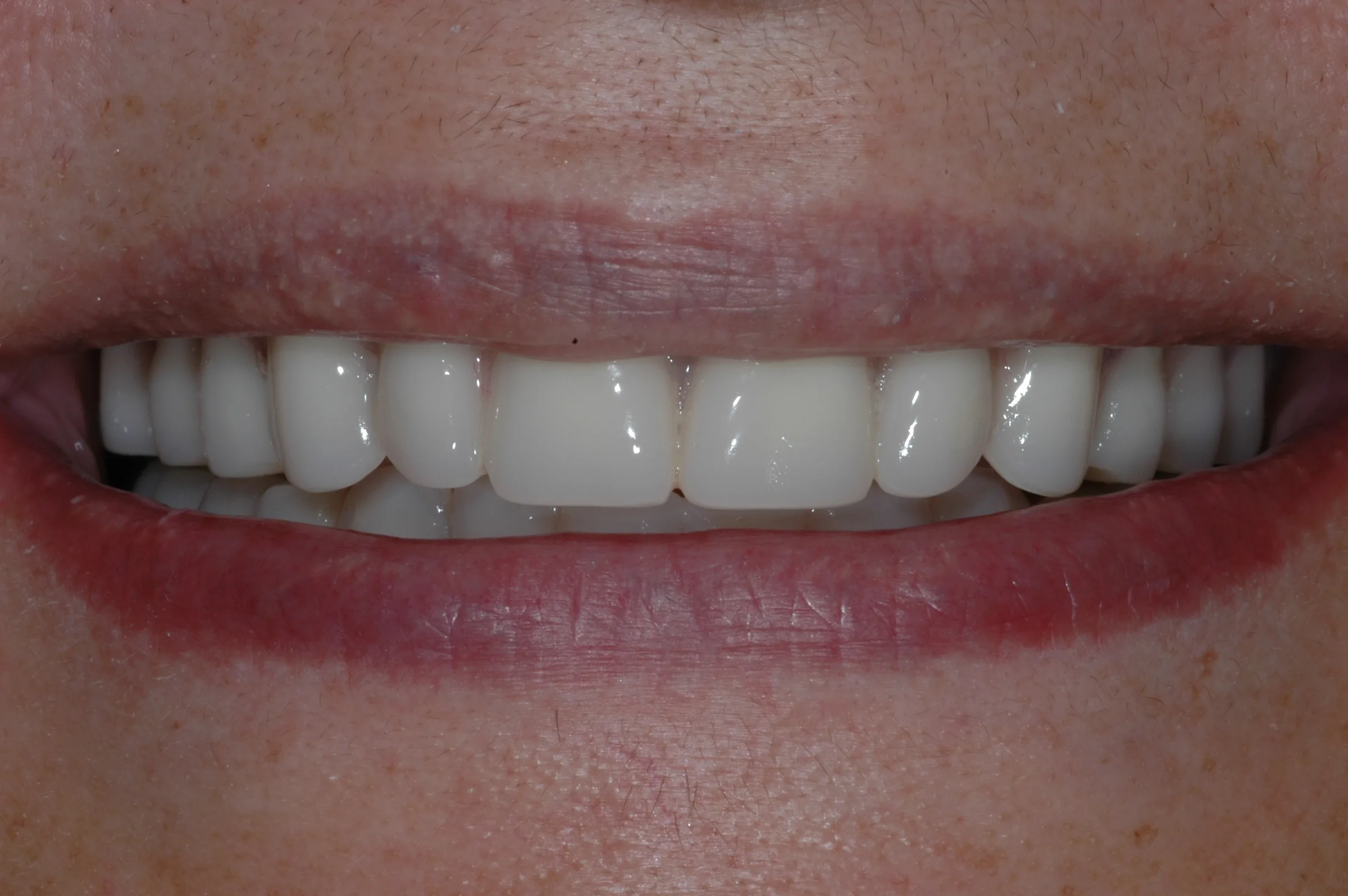 After — Snap-On Denture