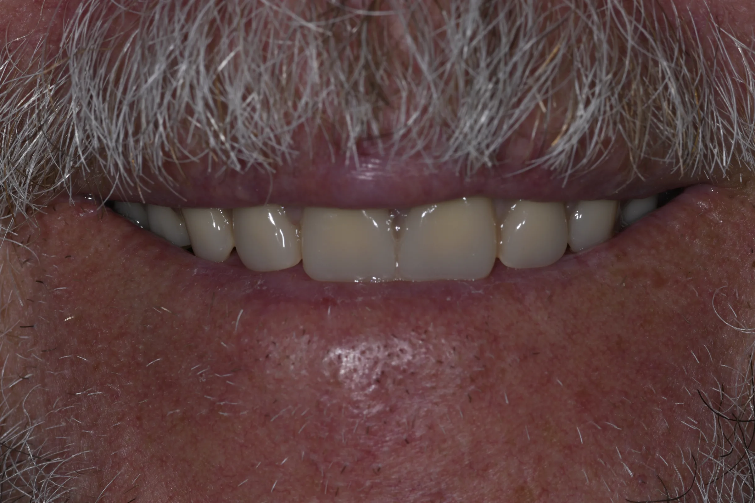 After — Dentures
