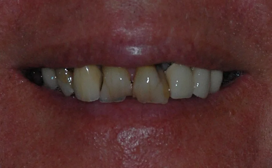 Before — Dentures