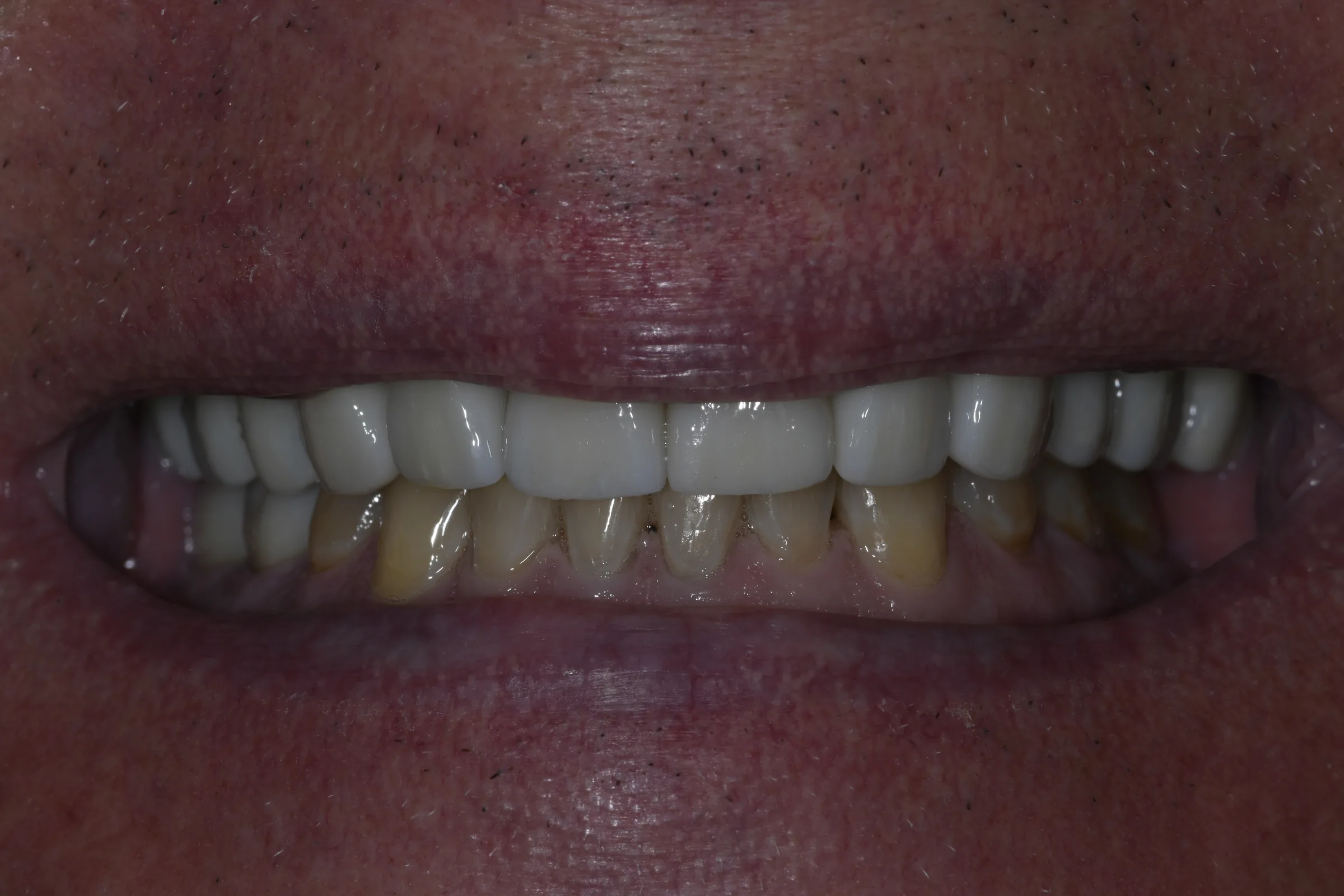 After — Full Mouth Reconstruction