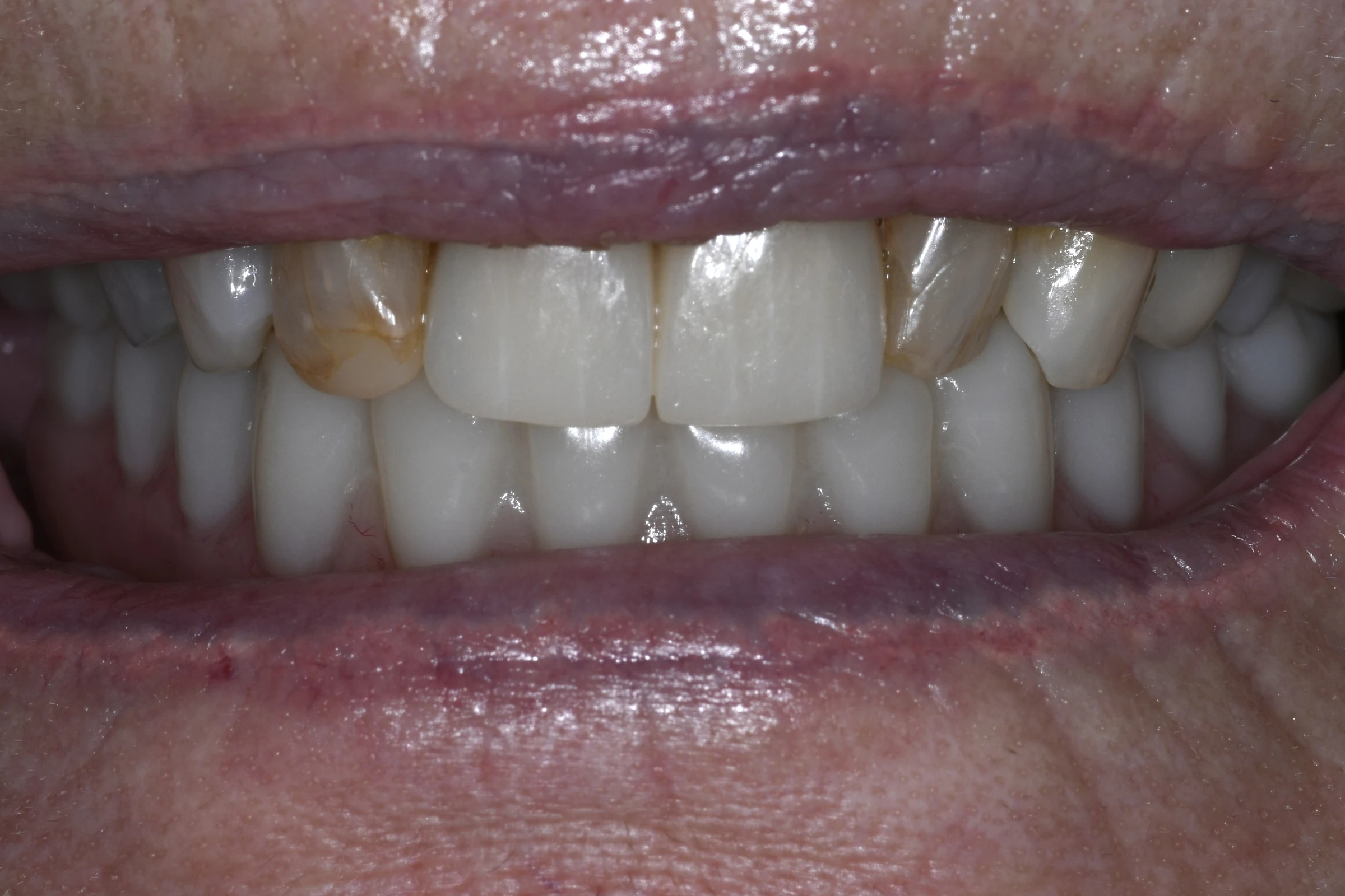 After — All-on-4 / Full Arch