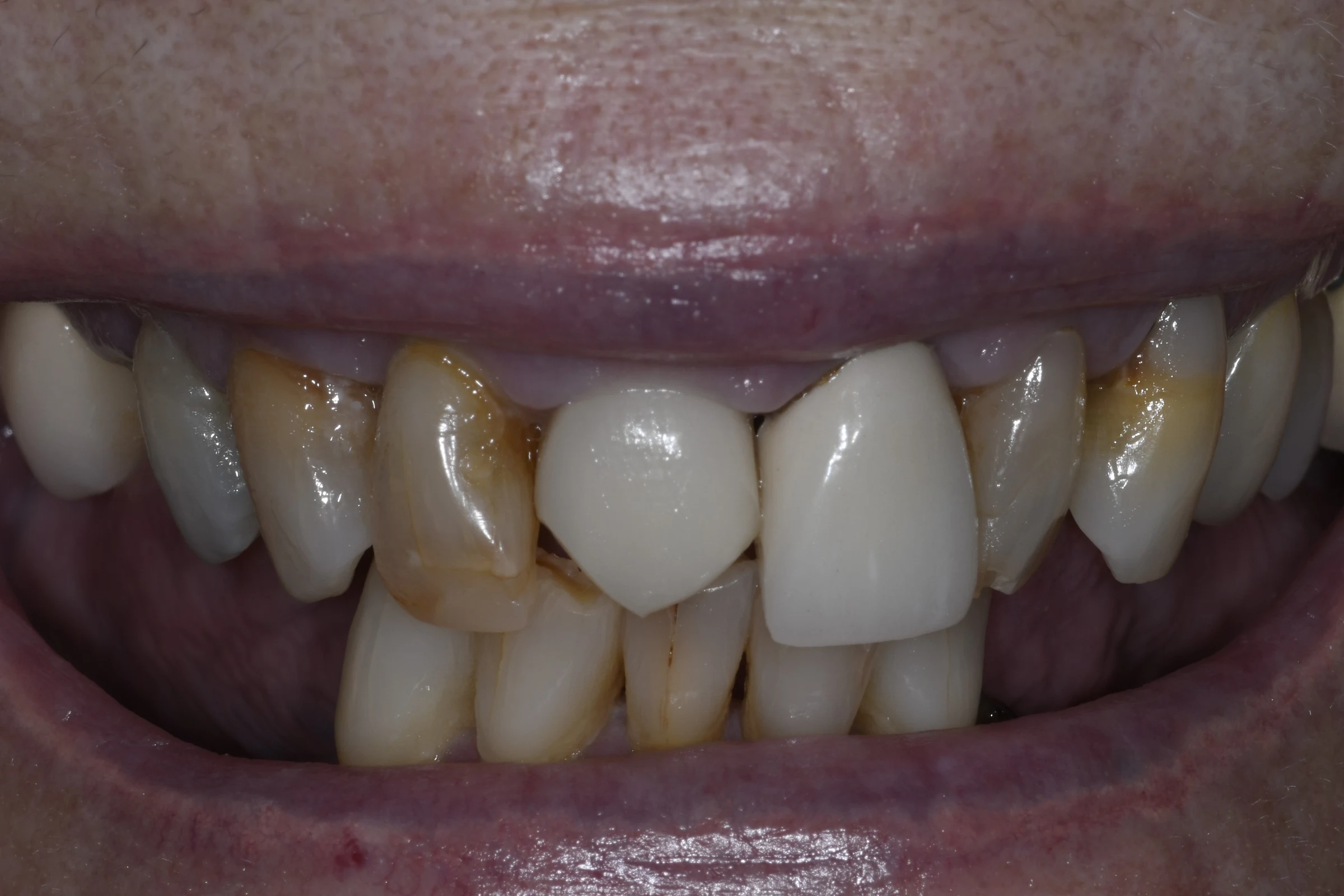 Before — All-on-4 / Full Arch