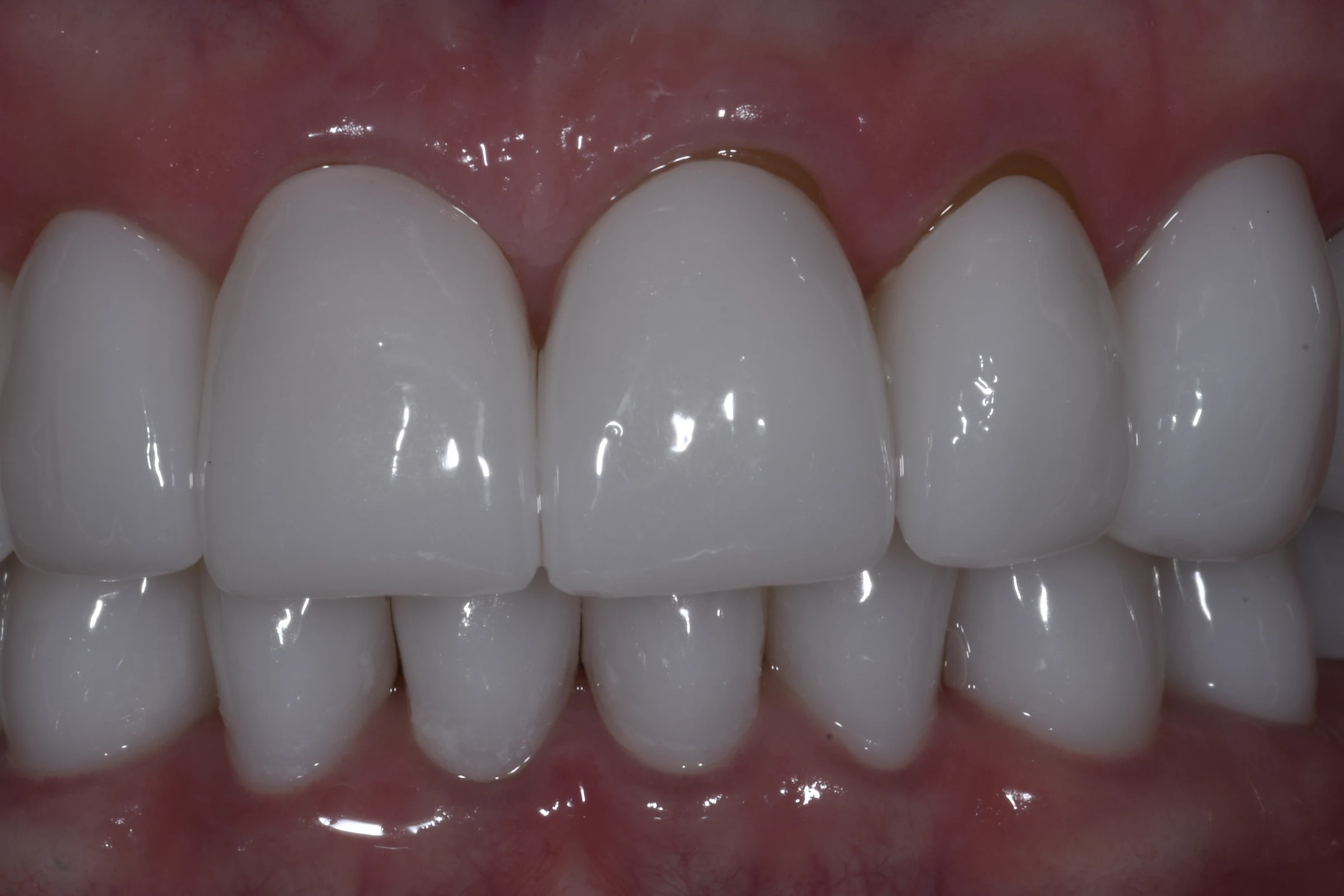 After — Full Mouth Reconstruction