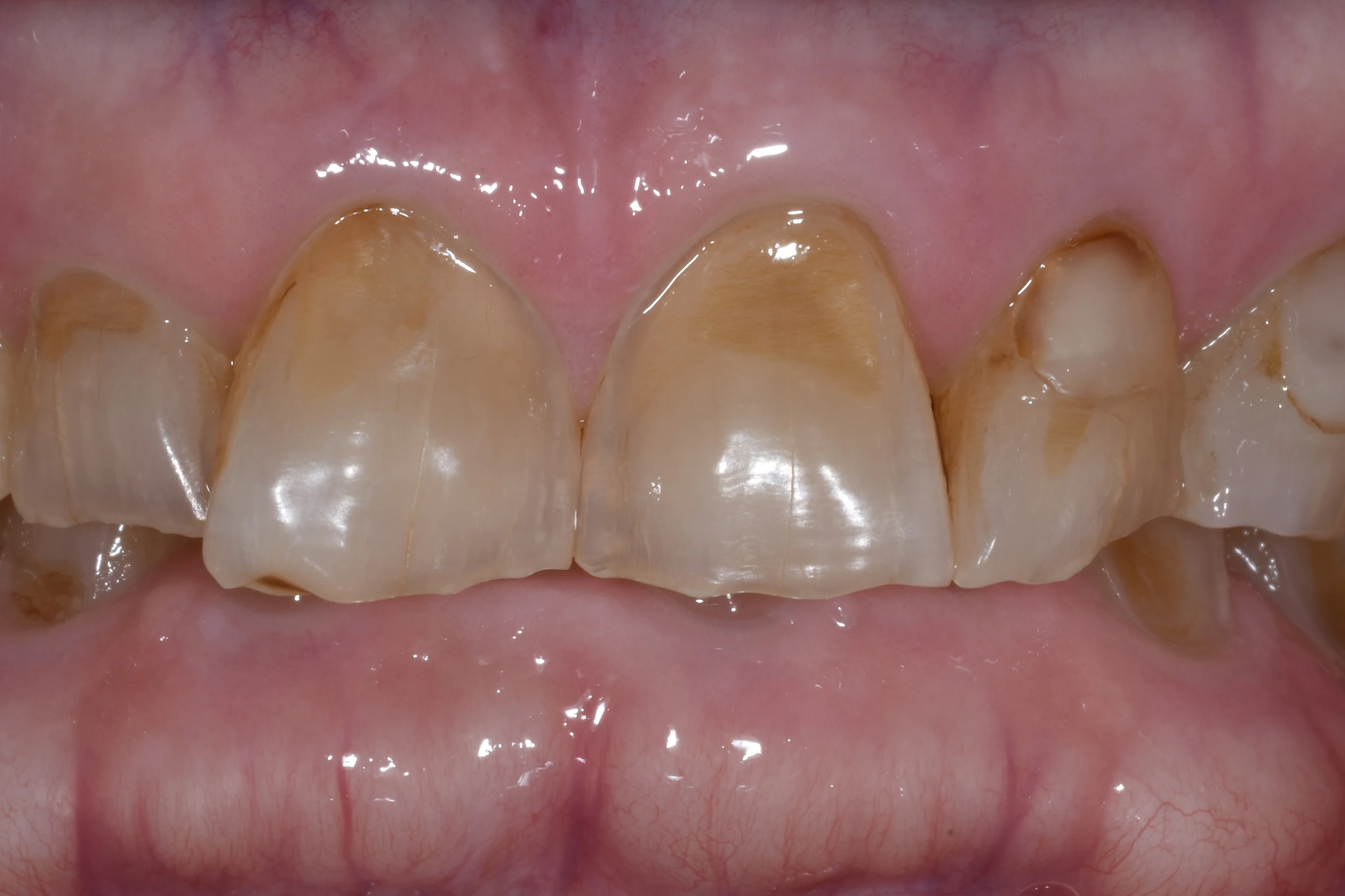 Before — Full Mouth Reconstruction